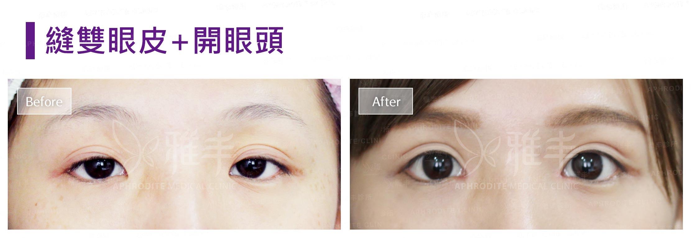 縫雙眼皮+開眼頭(Case8)