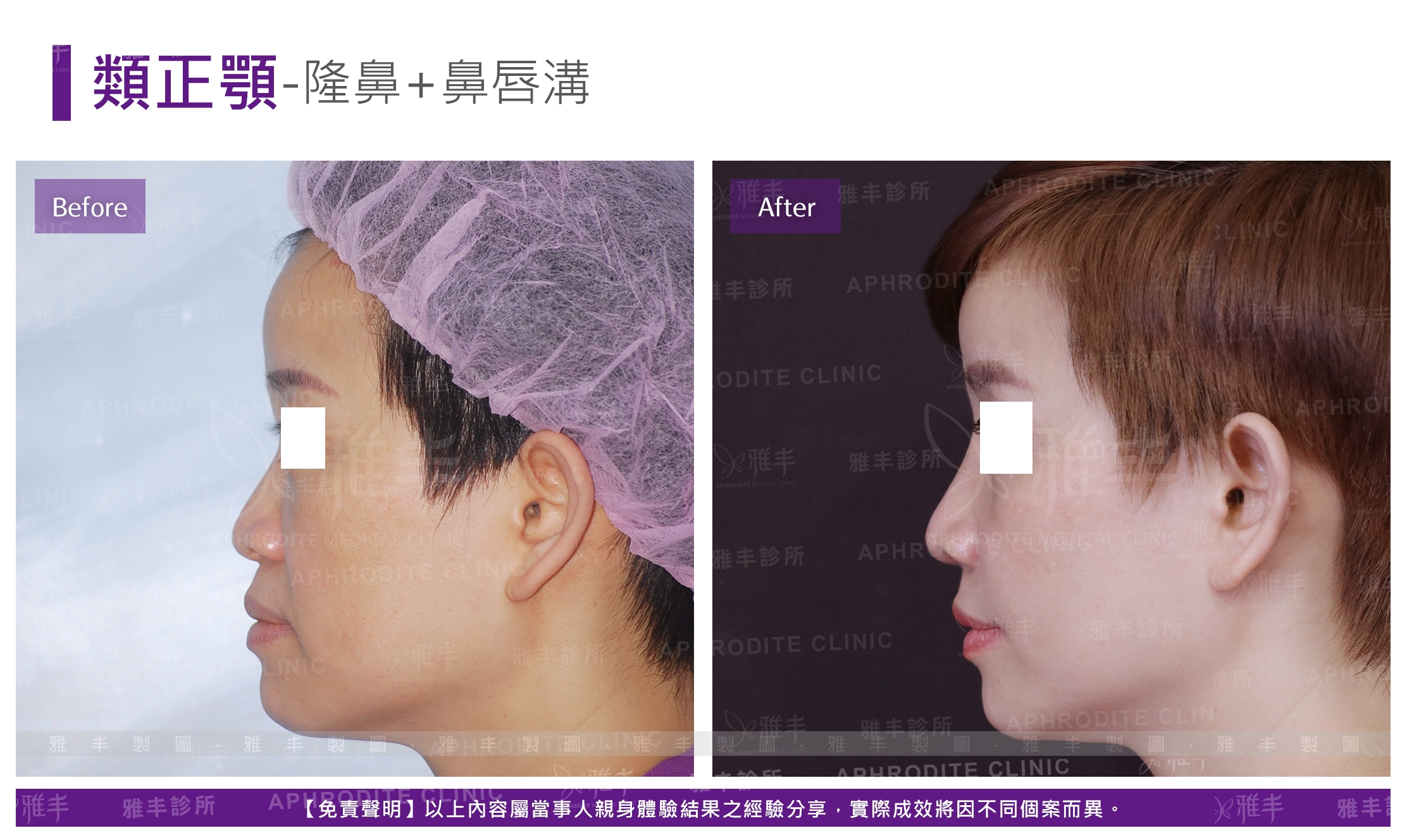 類正顎-隆鼻+鼻唇溝(Case1-L90)