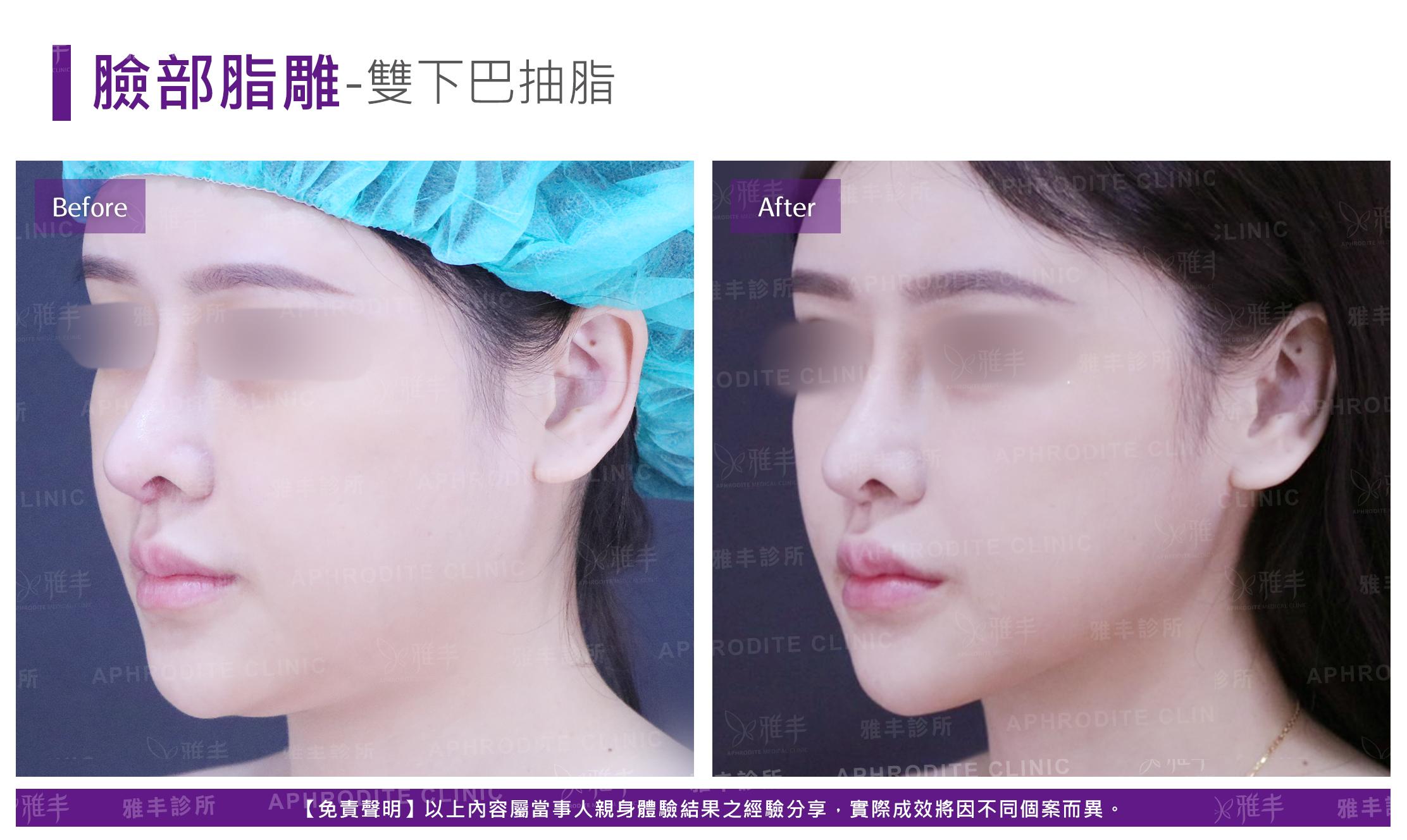 臉部脂雕-case3-L45.jpg
