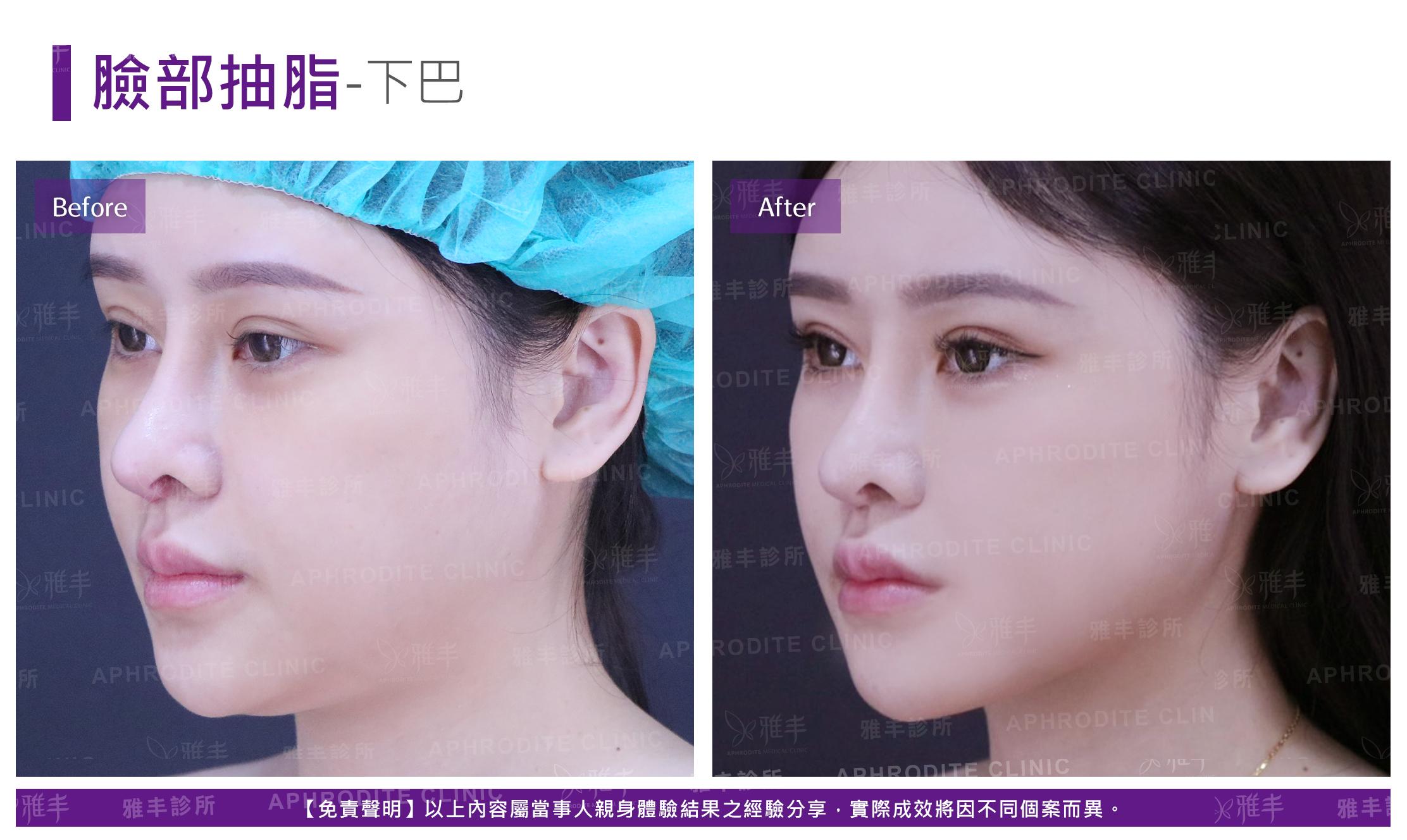 臉部抽-case3-L45