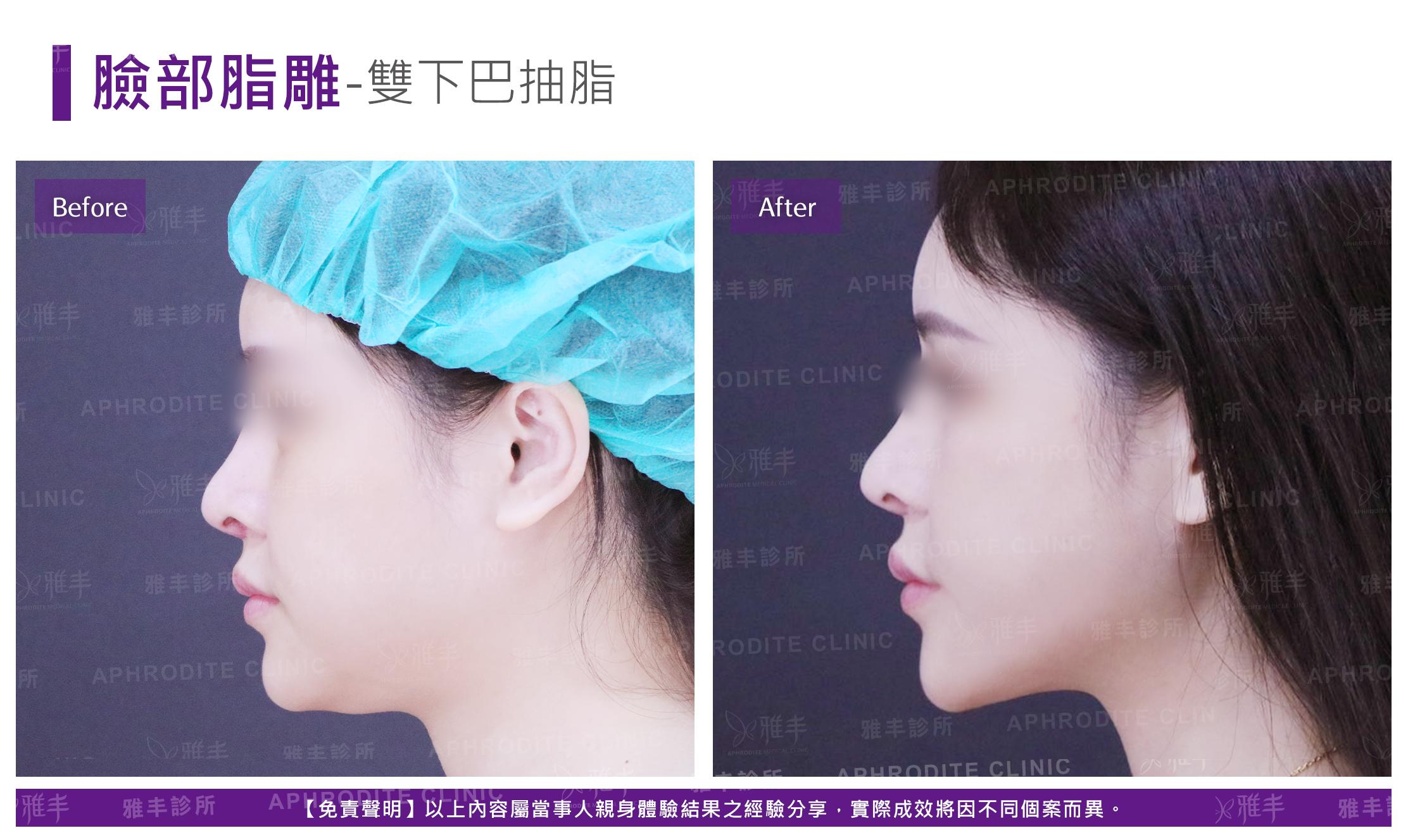 臉部脂雕-case3-L90.jpg