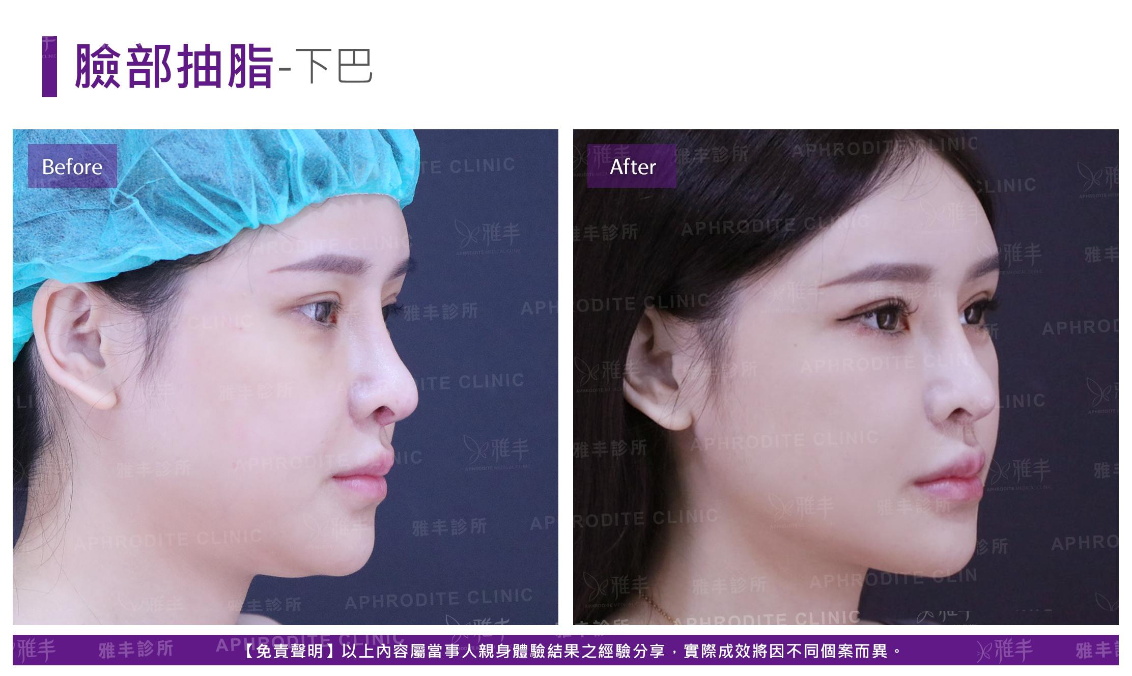 臉部抽脂-case3-R45.jpg