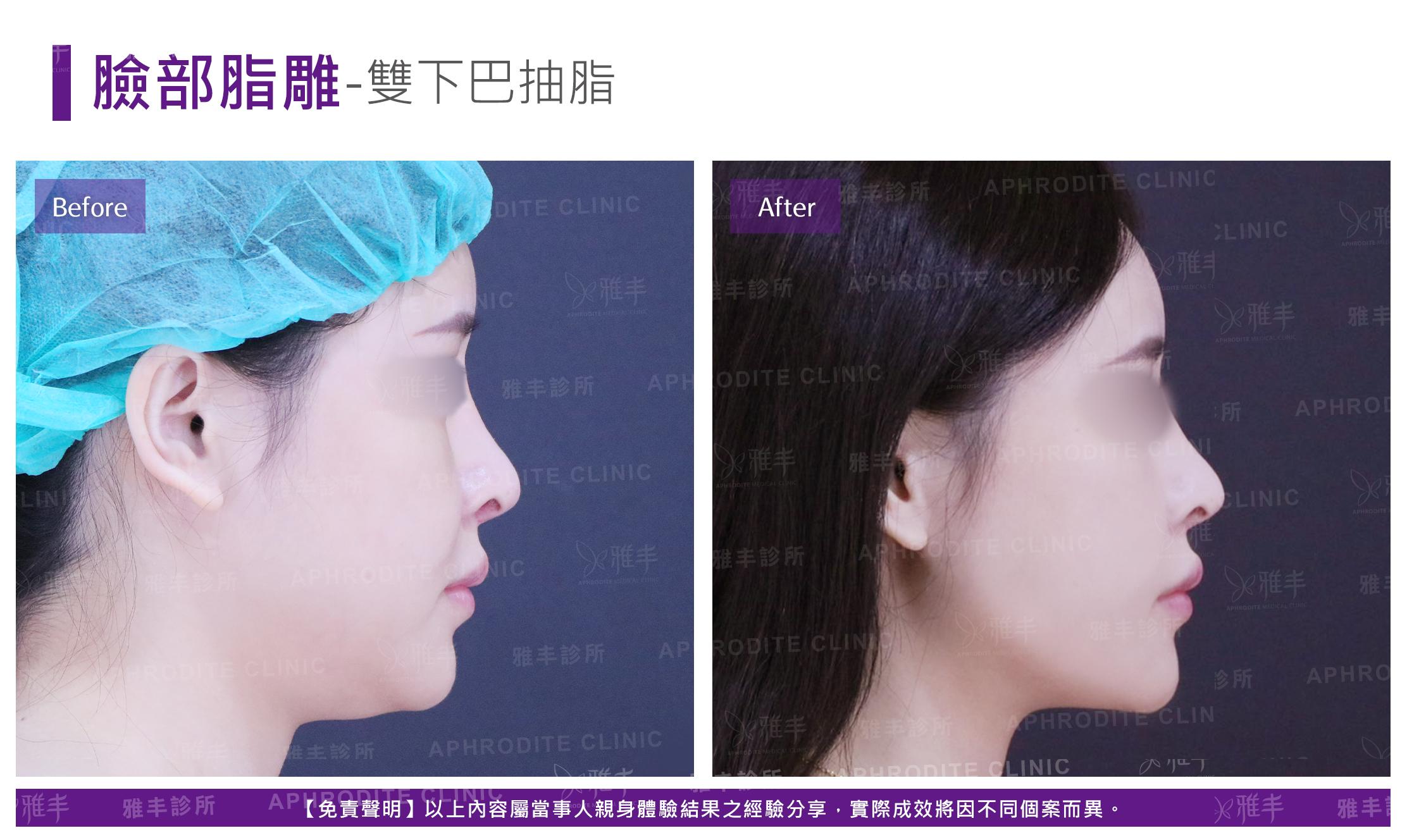 臉部脂雕-case3-R90.jpg