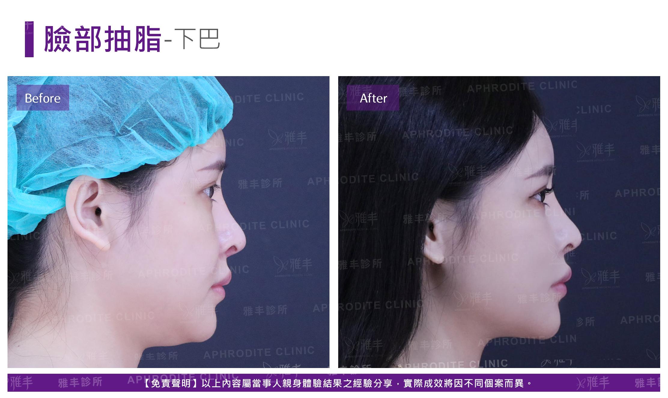 臉部抽脂-case3-R90.jpg