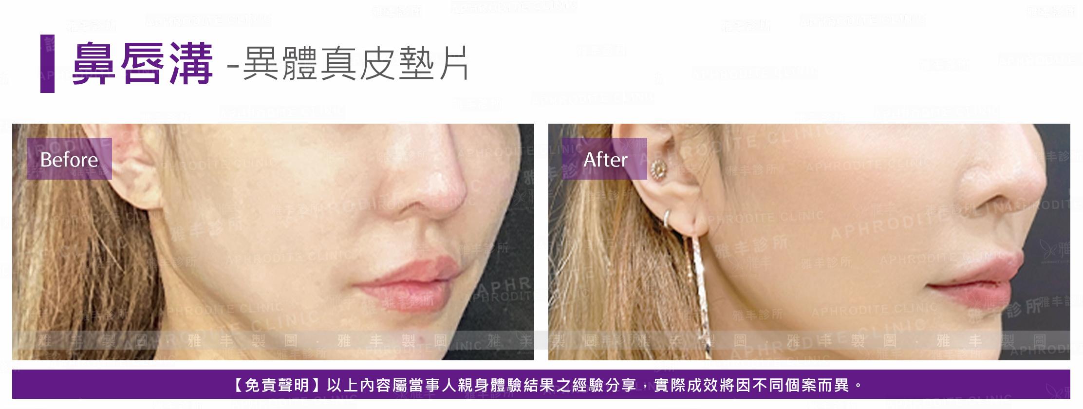 鼻唇溝-法令紋手術-case6-R45