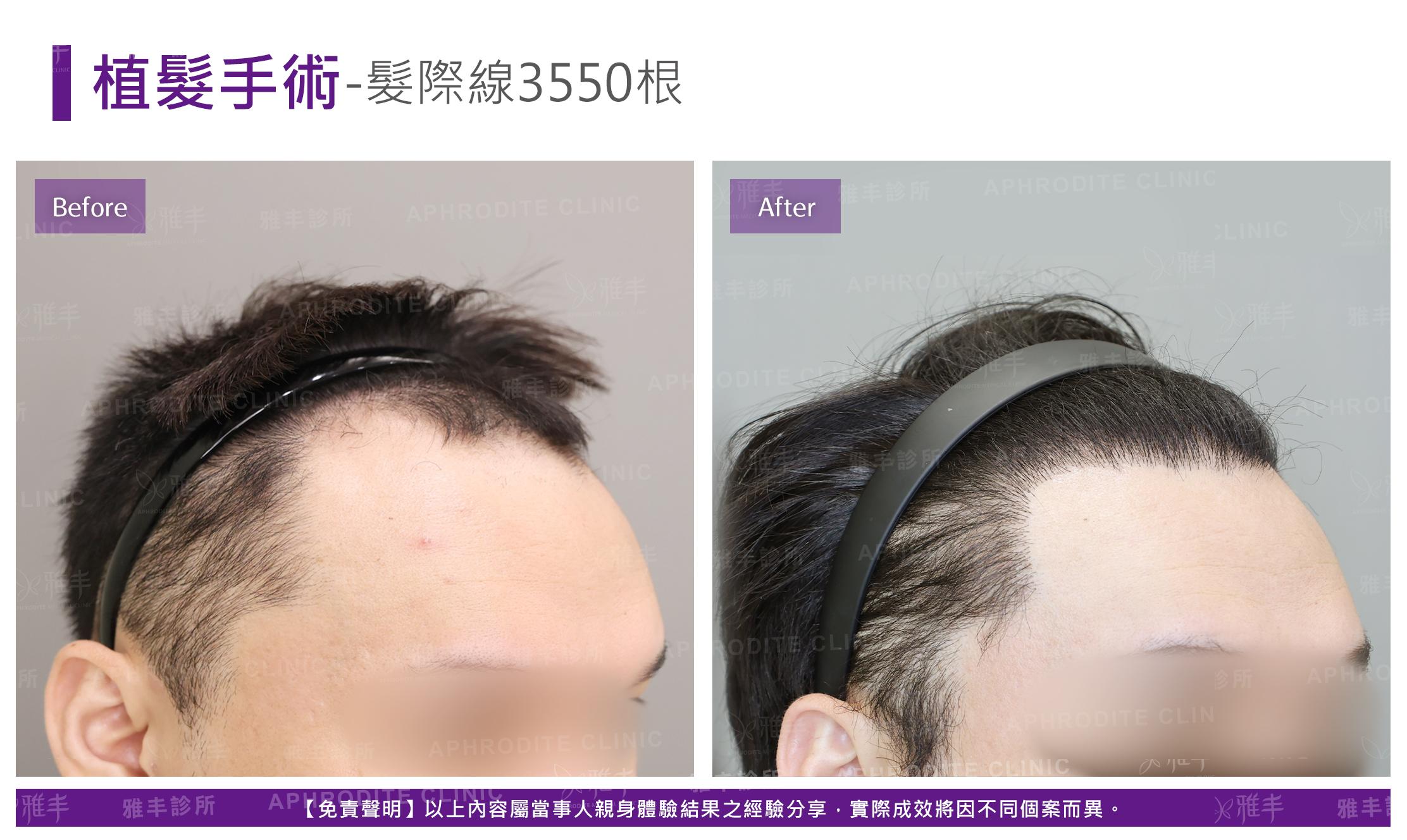 植髮手術-case11-R45.jpg