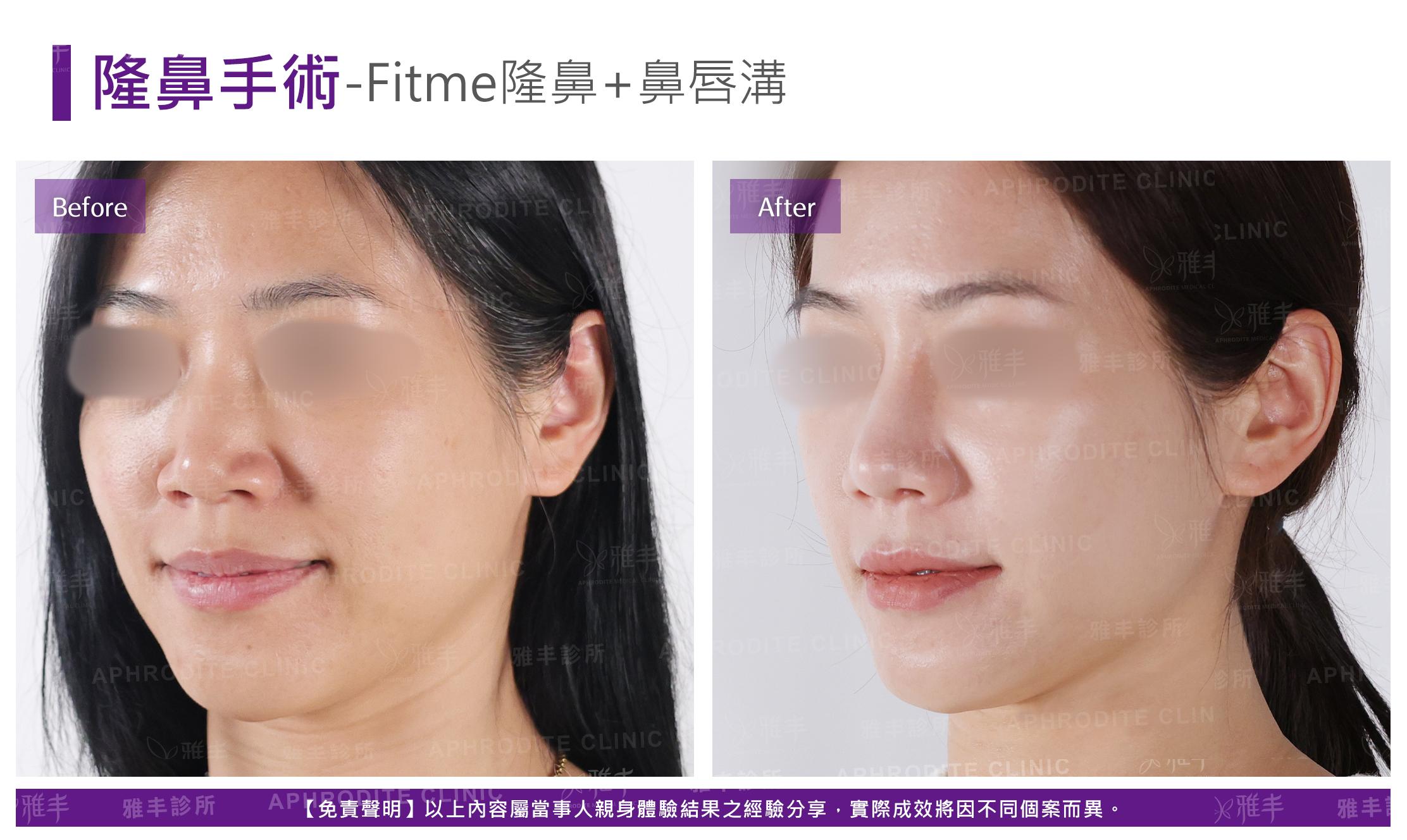 隆鼻手術-case20-L45.jpg