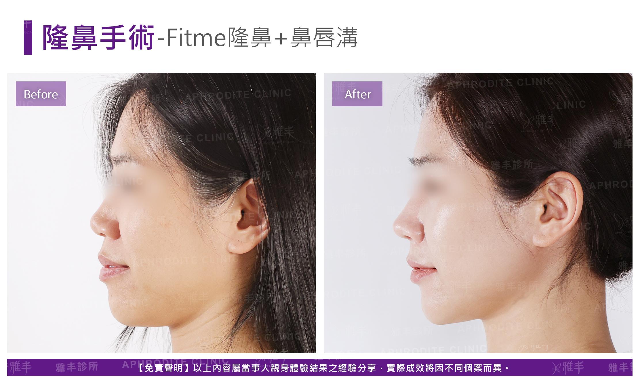 隆鼻手術-case20-L90.jpg
