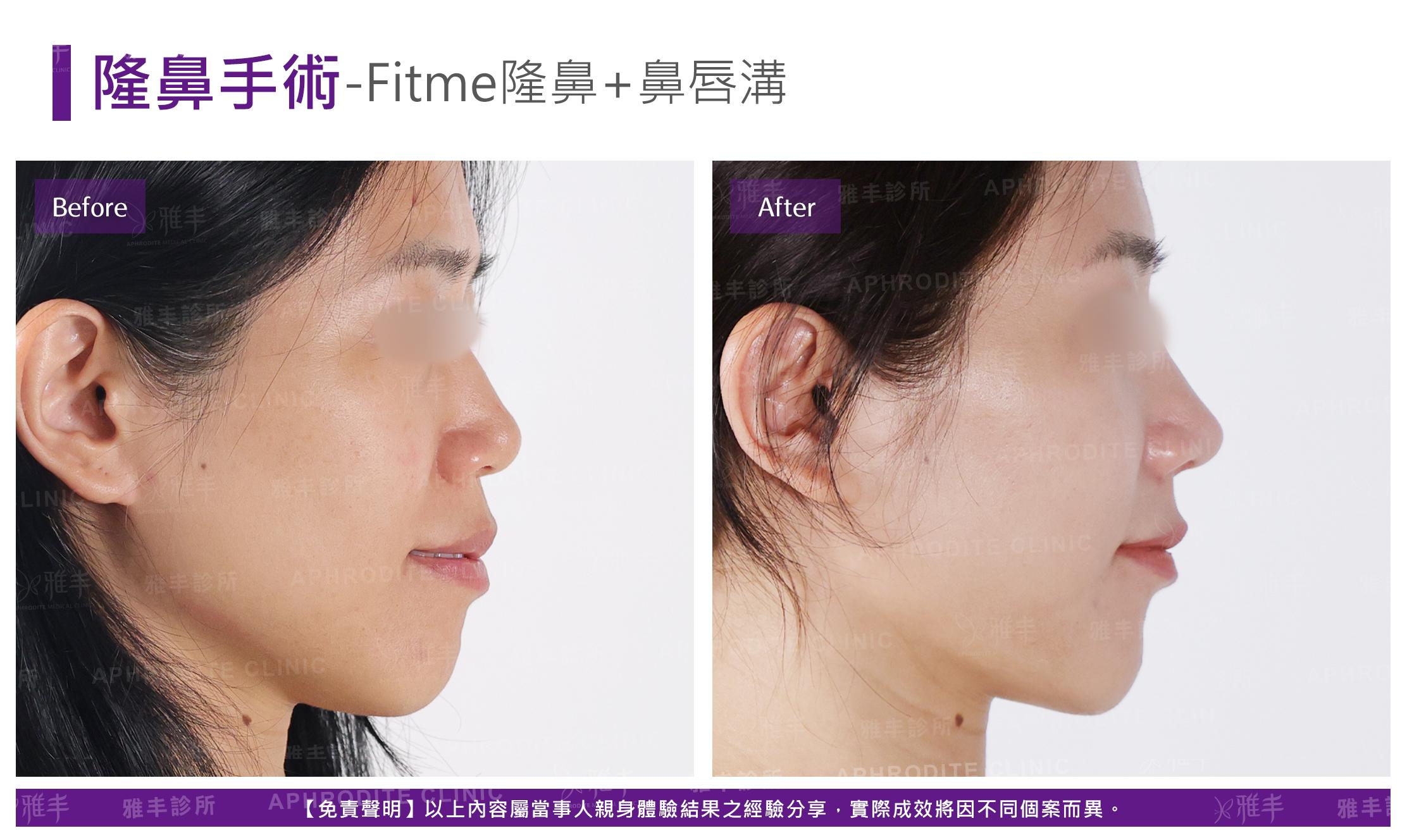 隆鼻手術-case20-R90.jpg