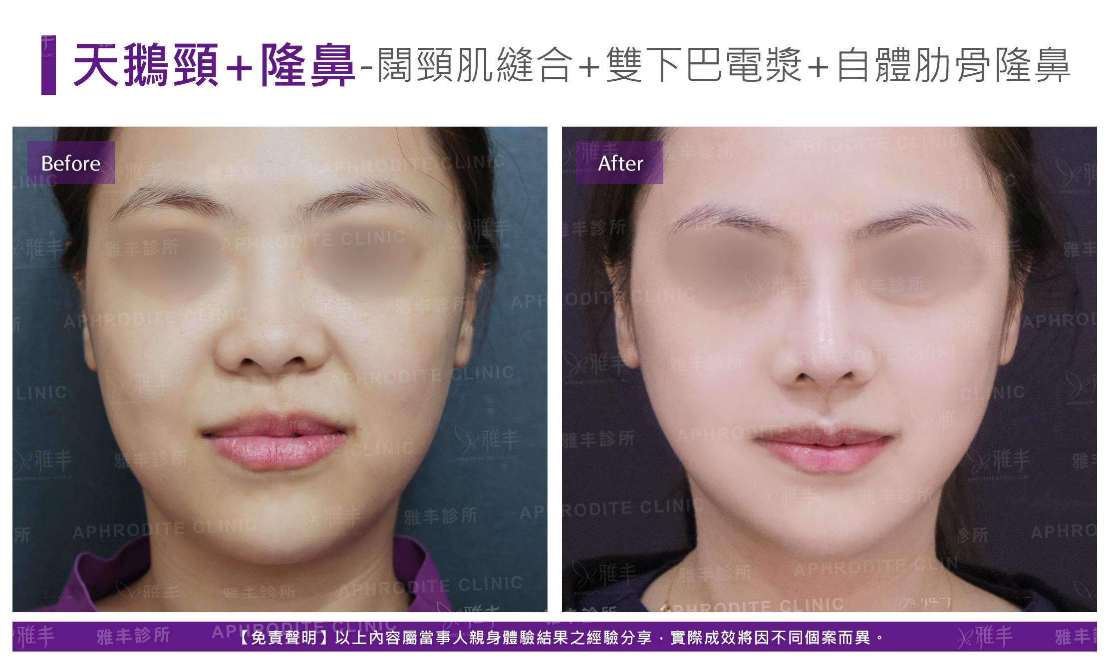 闊頸肌縫合-case21-F.jpg