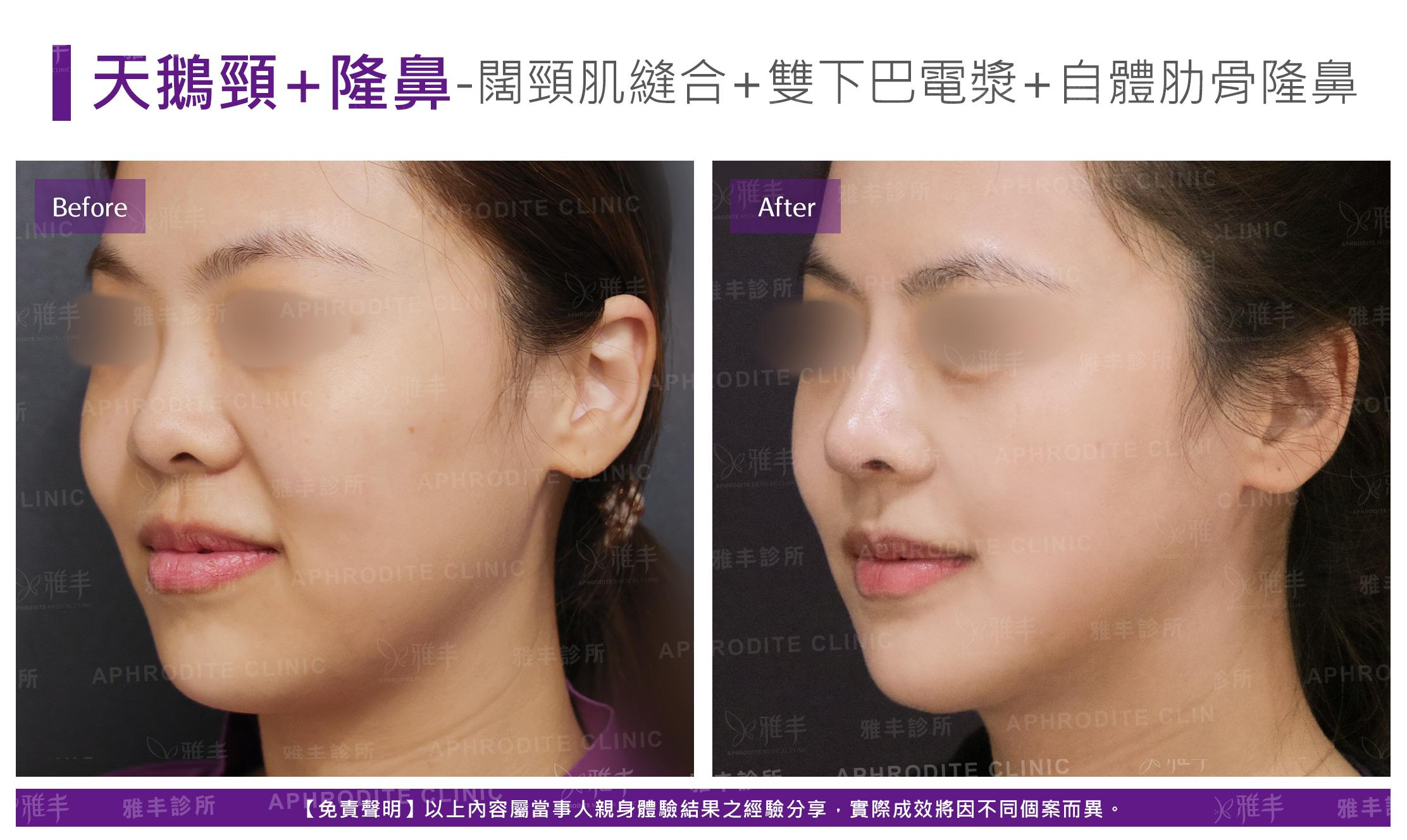 闊頸肌縫合-case21-L45.jpg