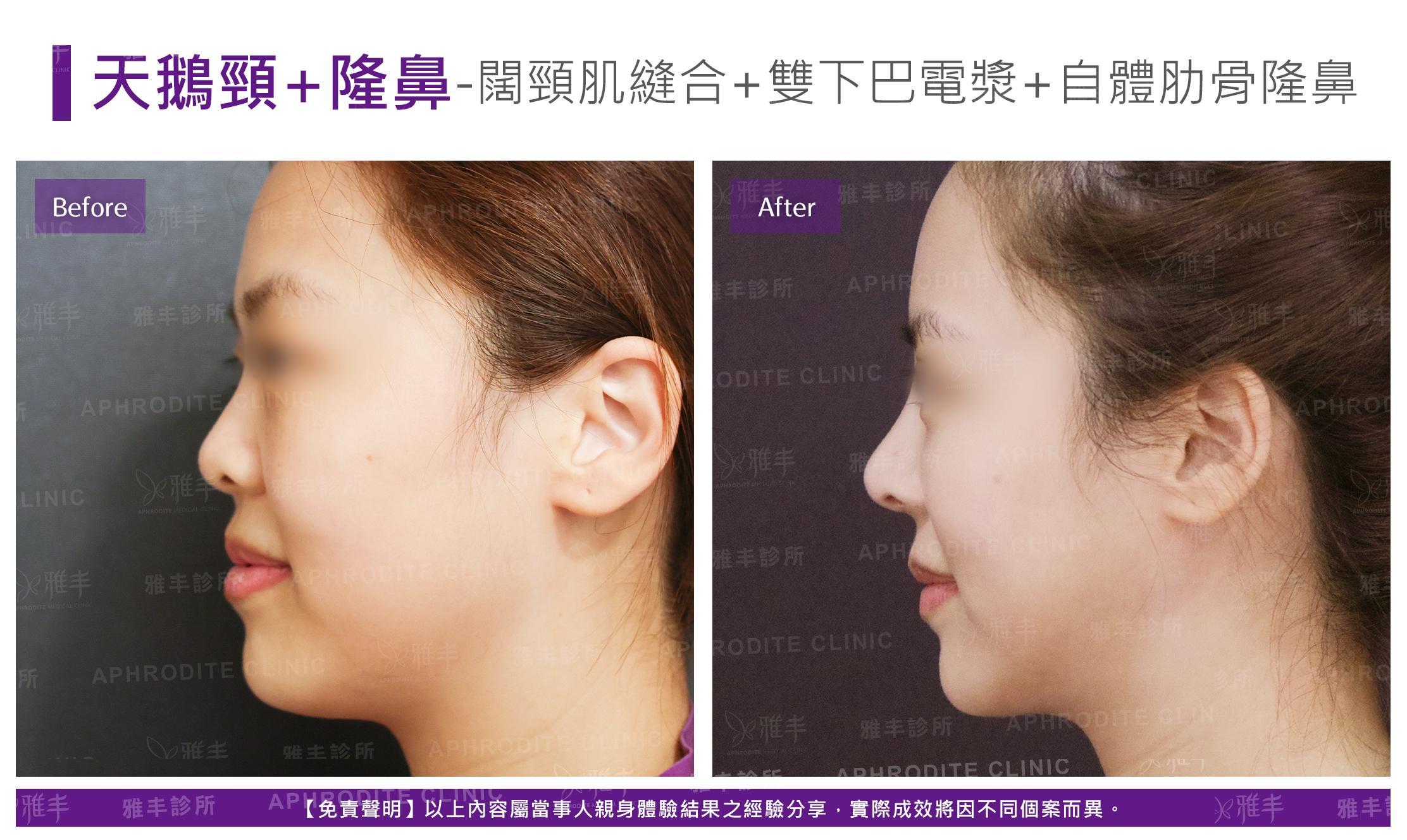 闊頸肌縫合-case21-L90.jpg
