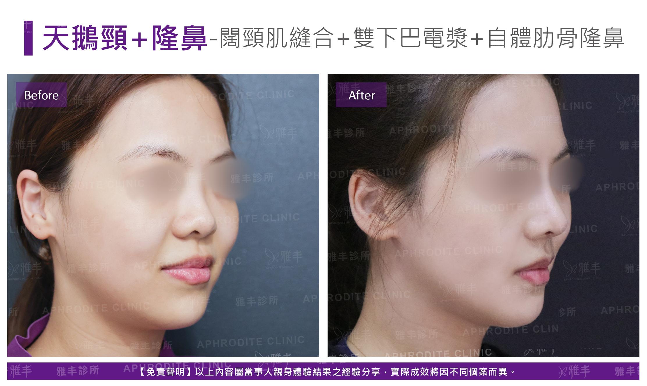 闊頸肌縫合-case21-R45.jpg