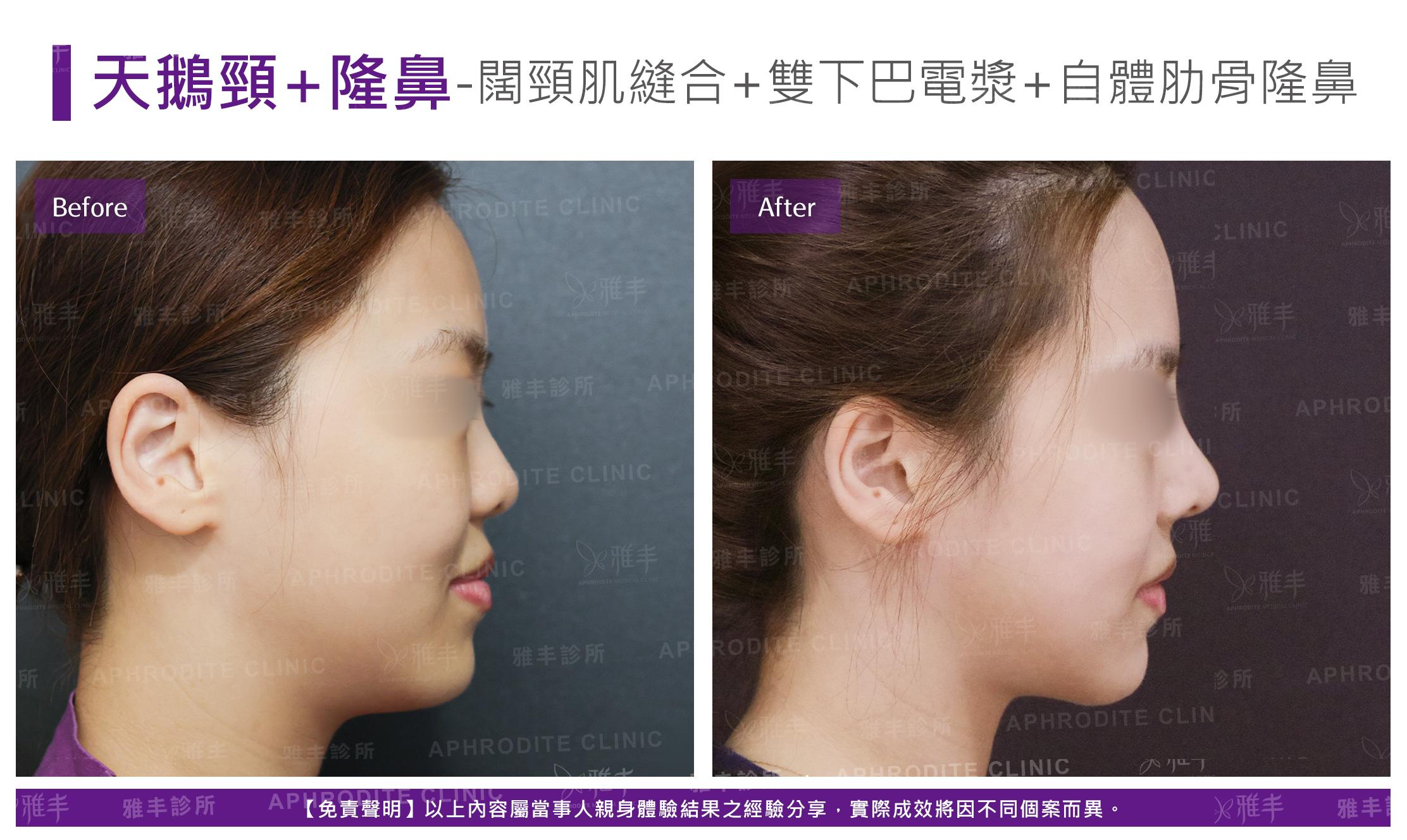 闊頸肌縫合-case21-R90.jpg