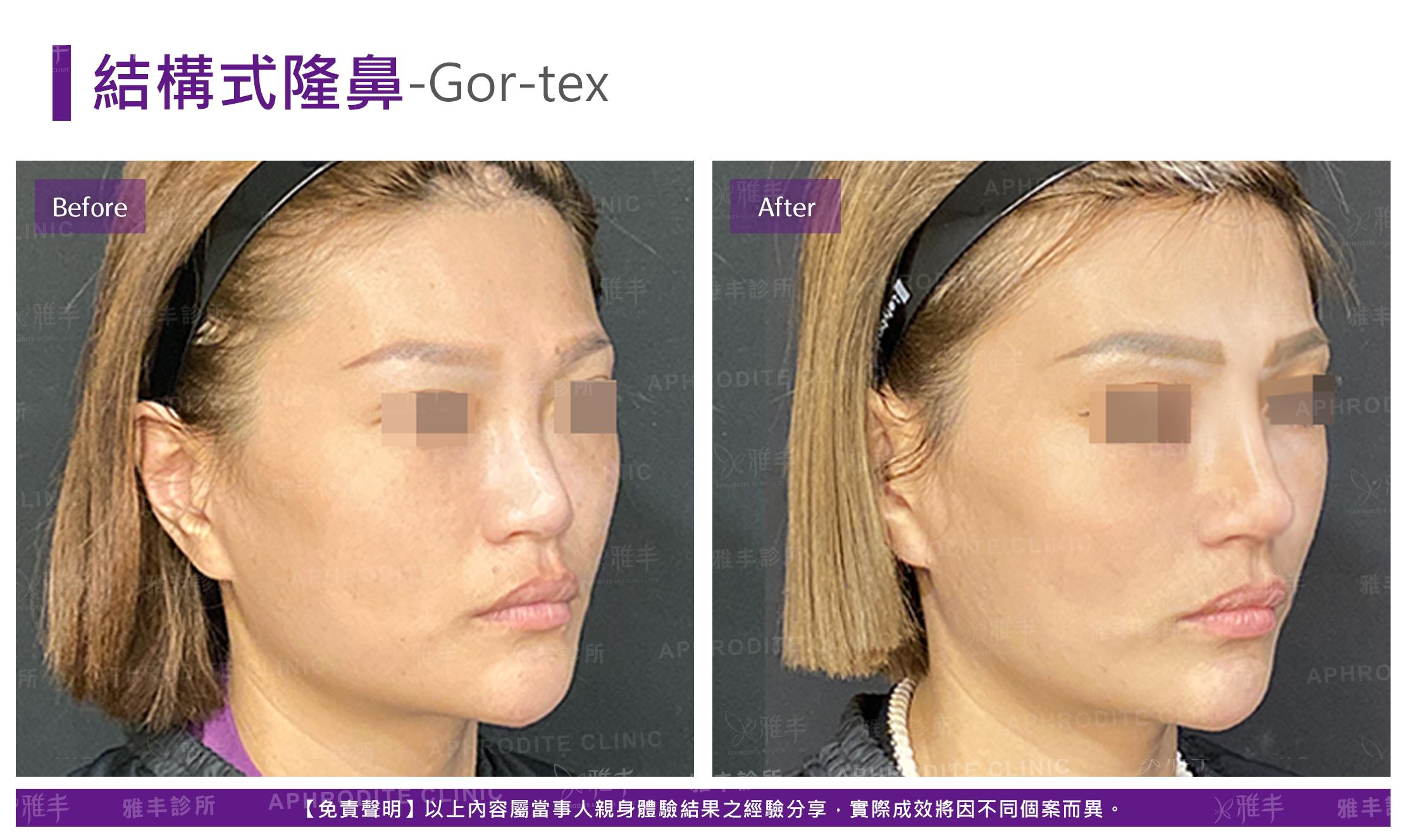 結構式隆鼻-case22-R45.jpg