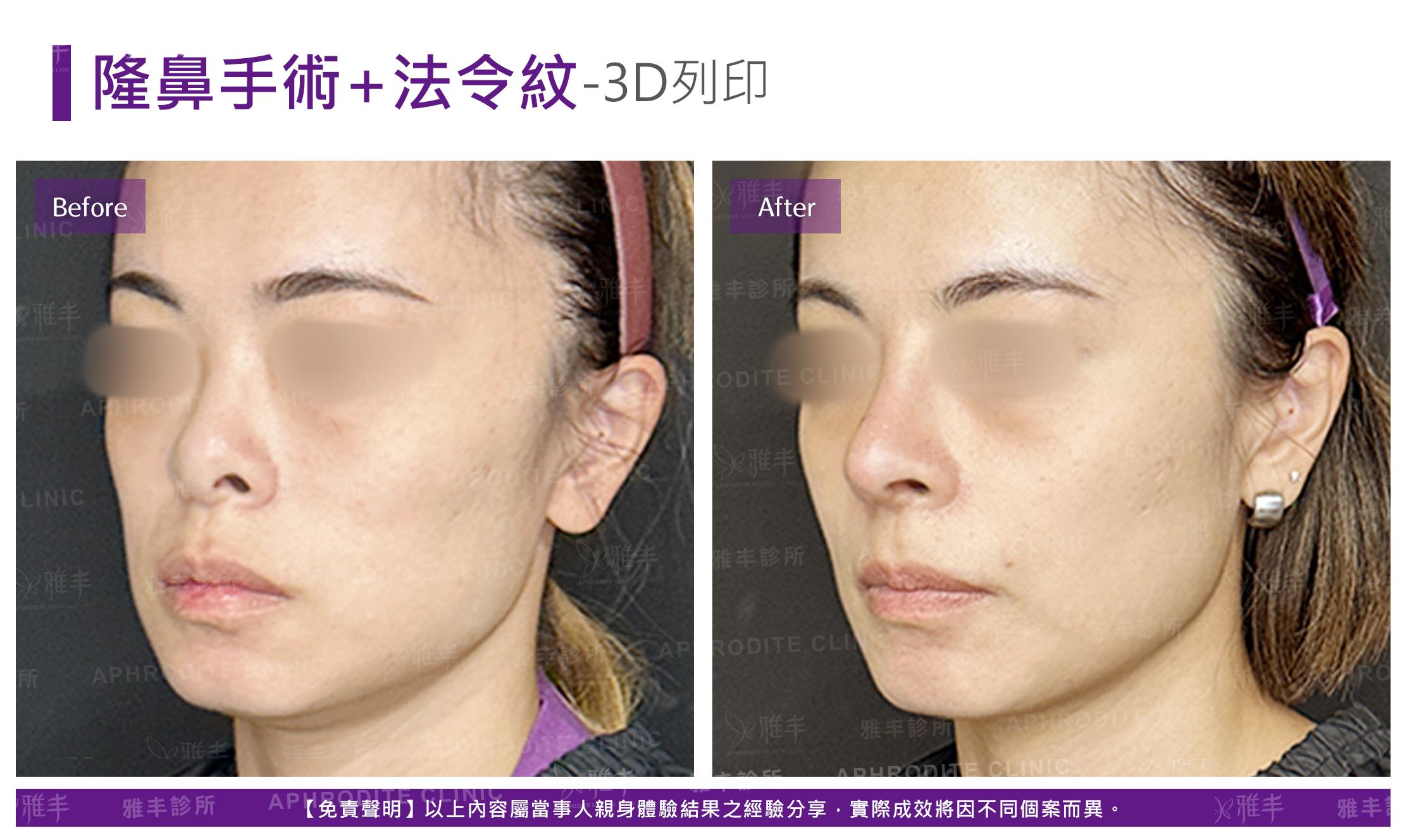隆鼻手術-case23-L45.jpg