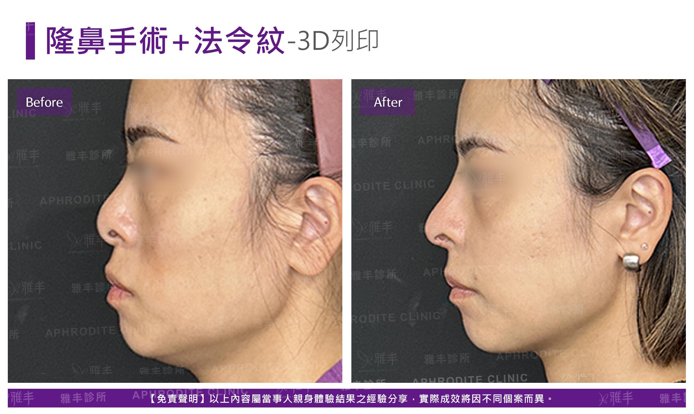 隆鼻手術-case23-L90.jpg