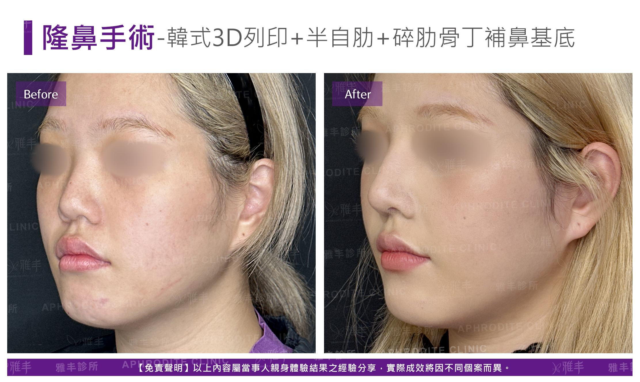 隆鼻手術-case24-L45.jpg