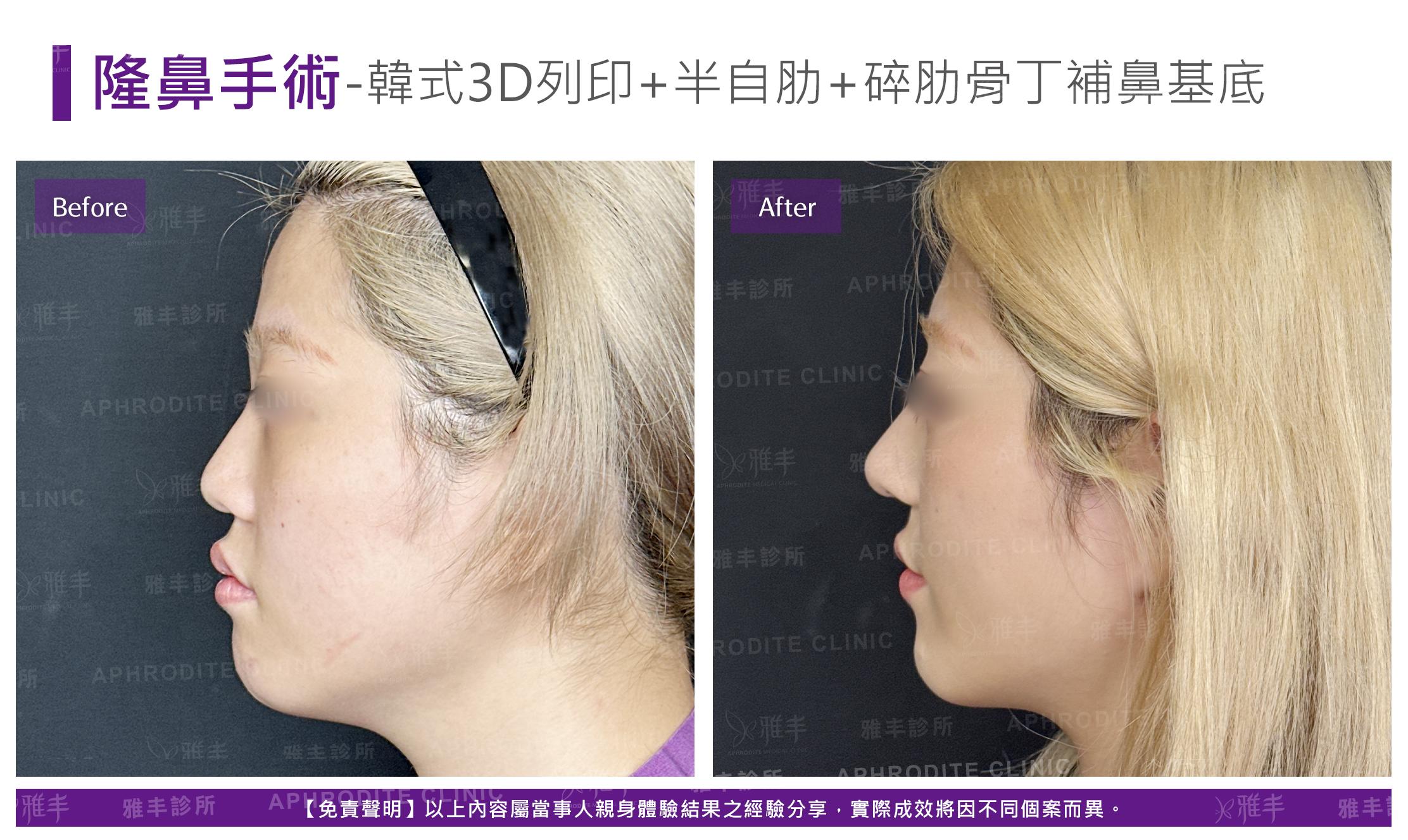 隆鼻手術-case24-L90.jpg