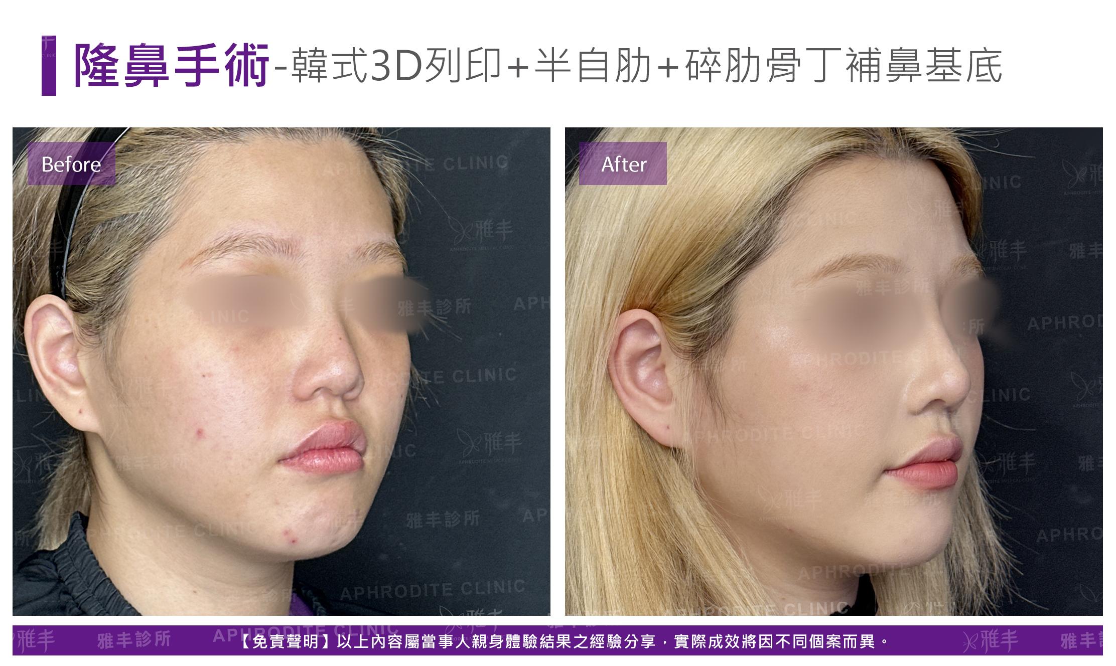 隆鼻手術-case24-R45.jpg