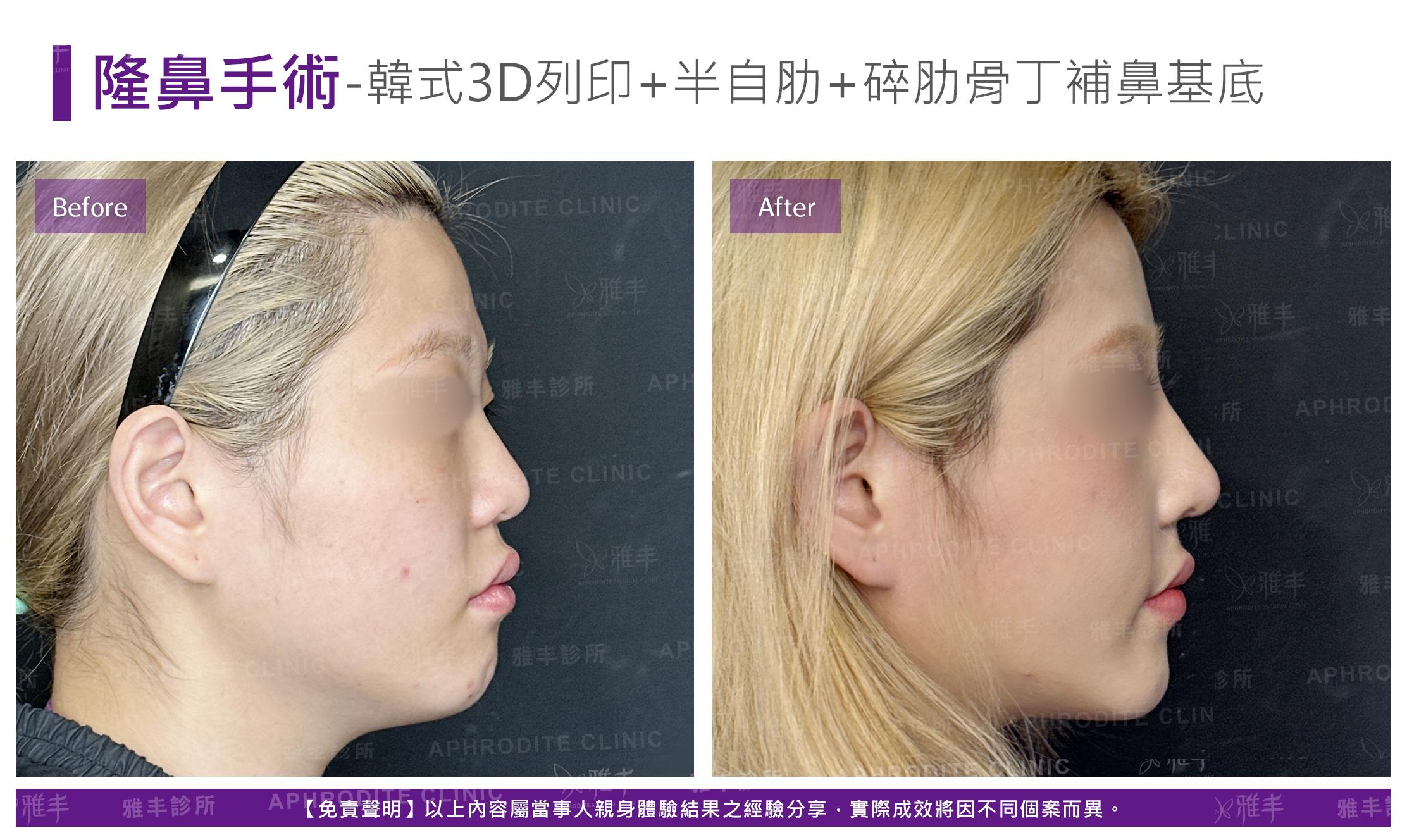 隆鼻手術-case24-R90.jpg