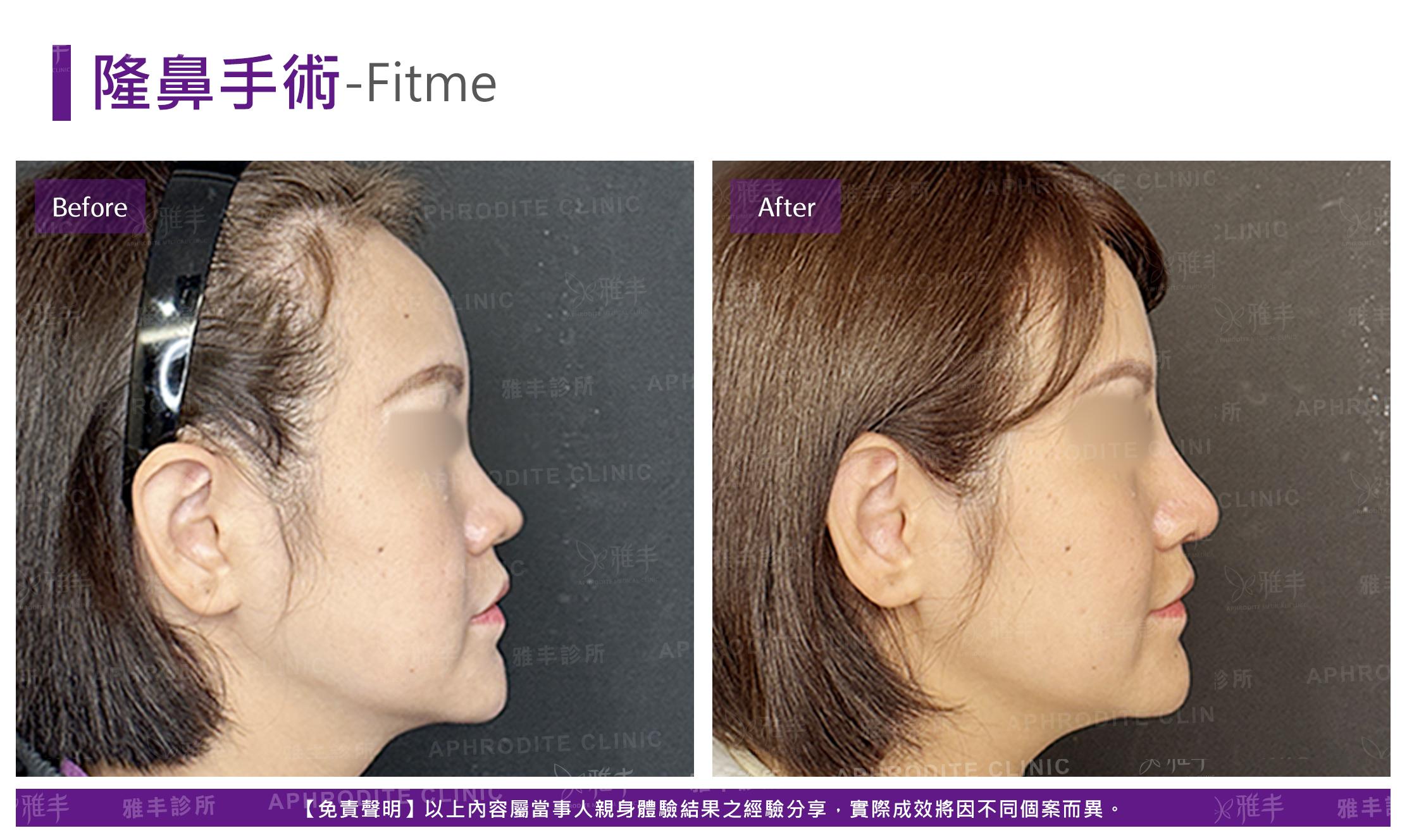 隆鼻手術case25-F-R90.jpg