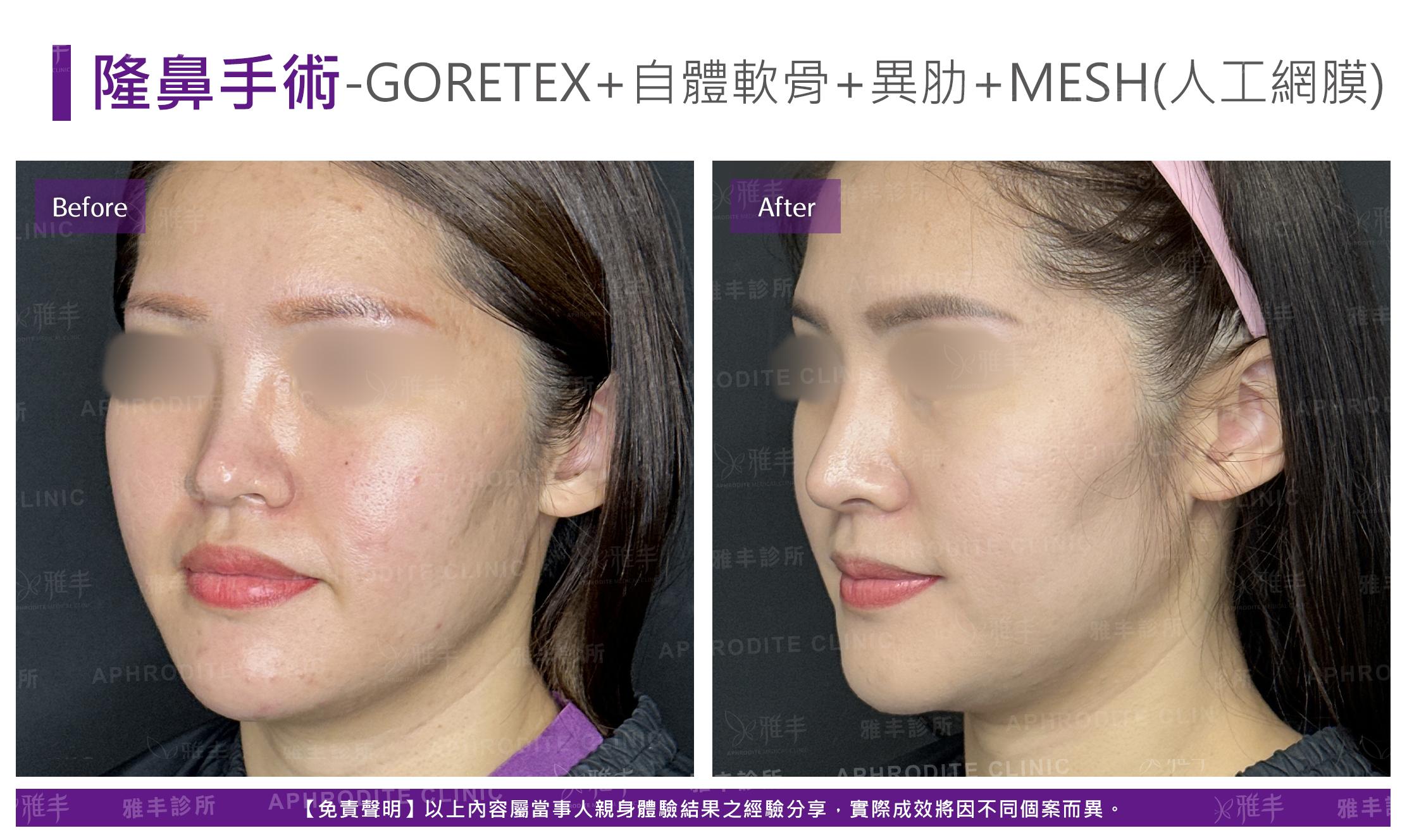 隆鼻手術-case25-L45.jpg