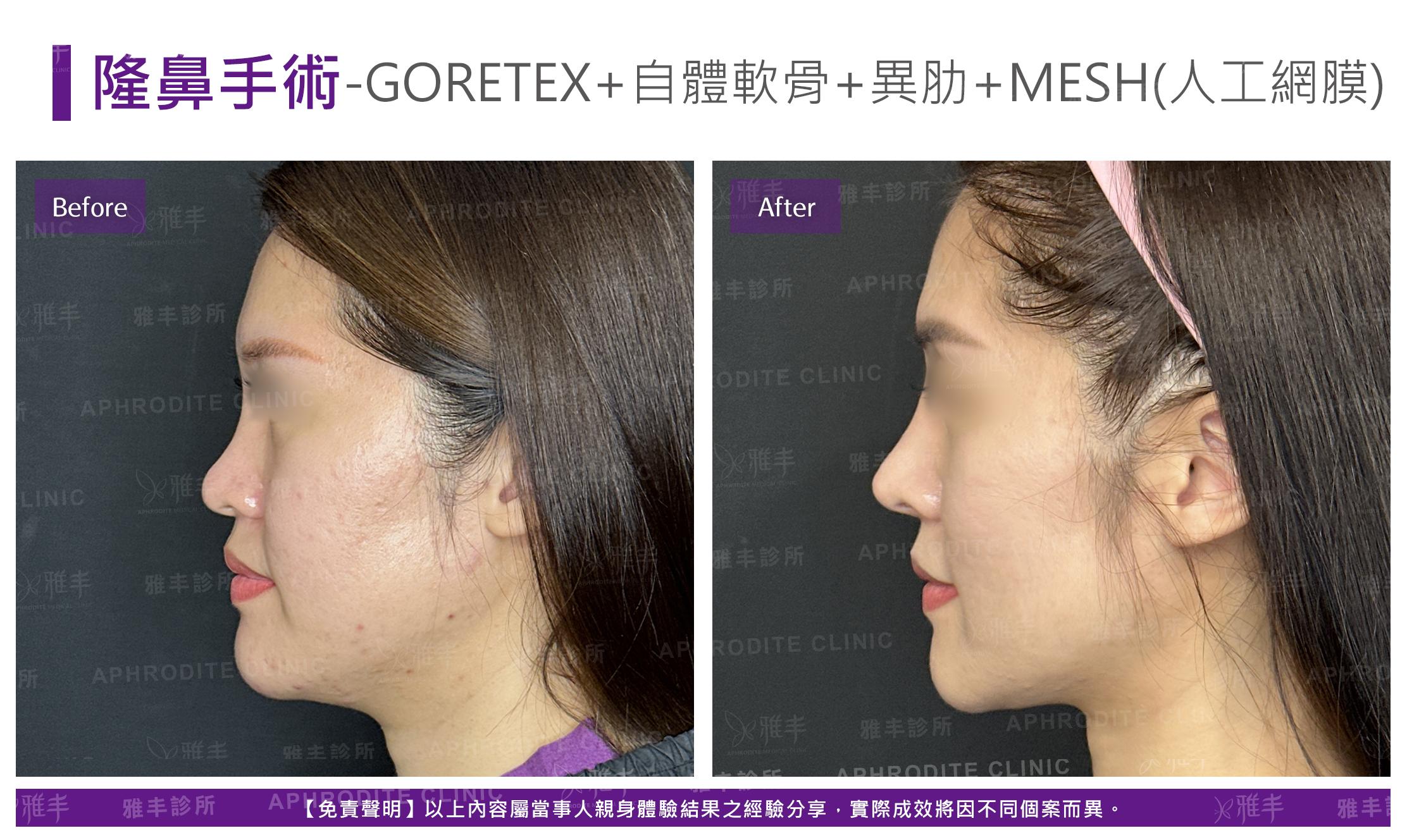 隆鼻手術-case25-L90.jpg