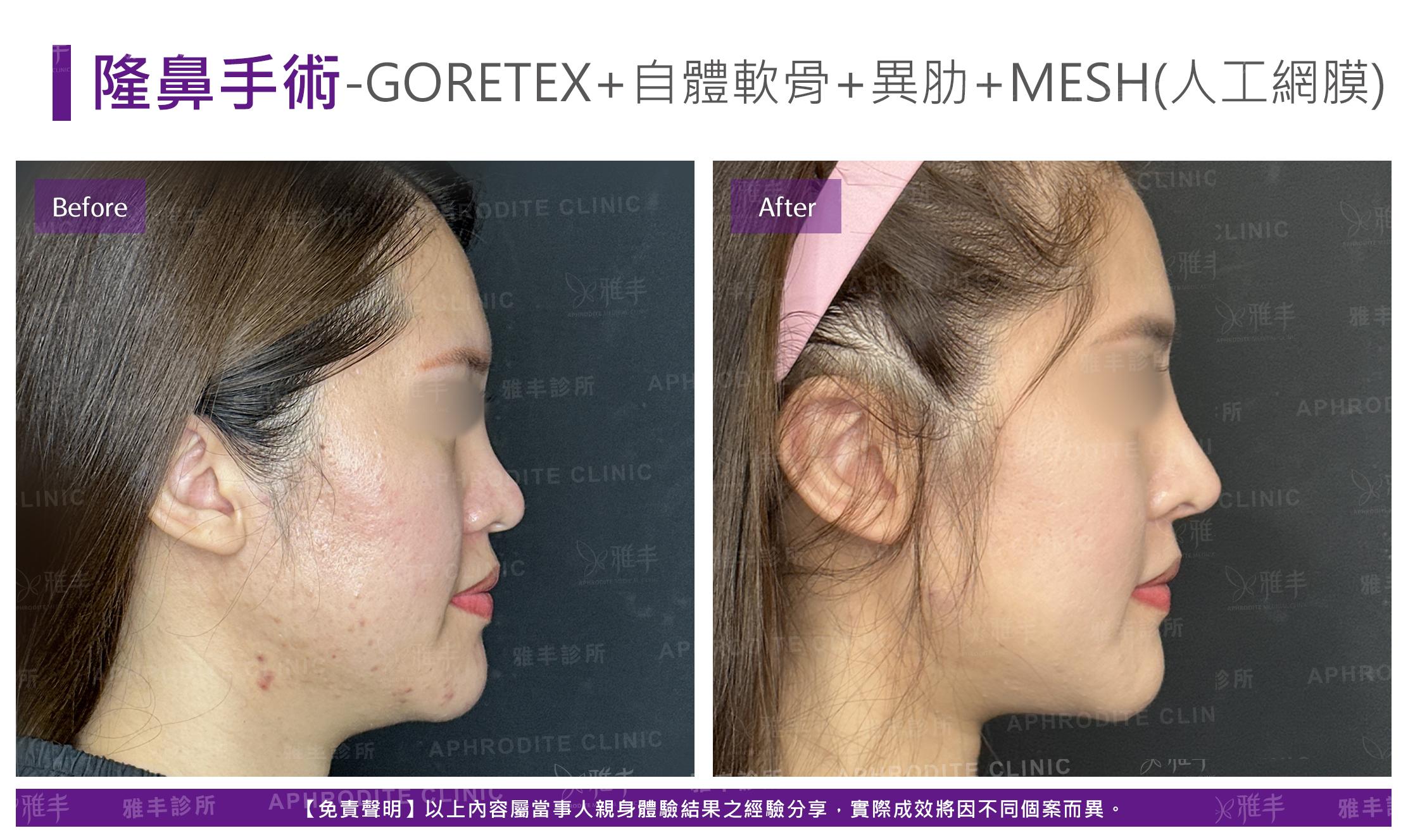 隆鼻手術-case25-R90.jpg
