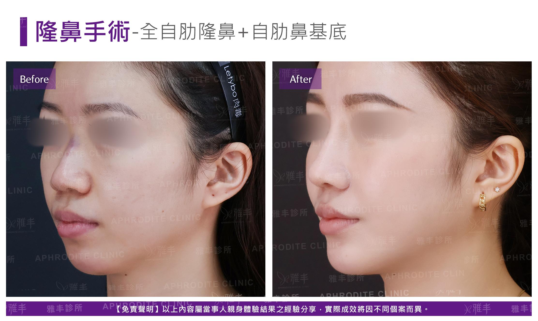 隆鼻手術-case26-L45.jpg