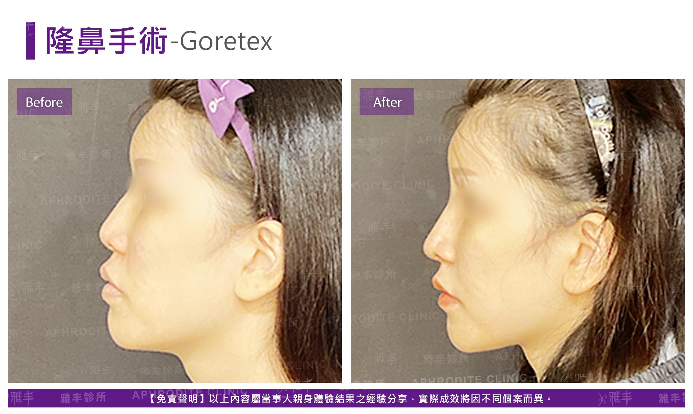 隆鼻手術-case26-L90.jpg