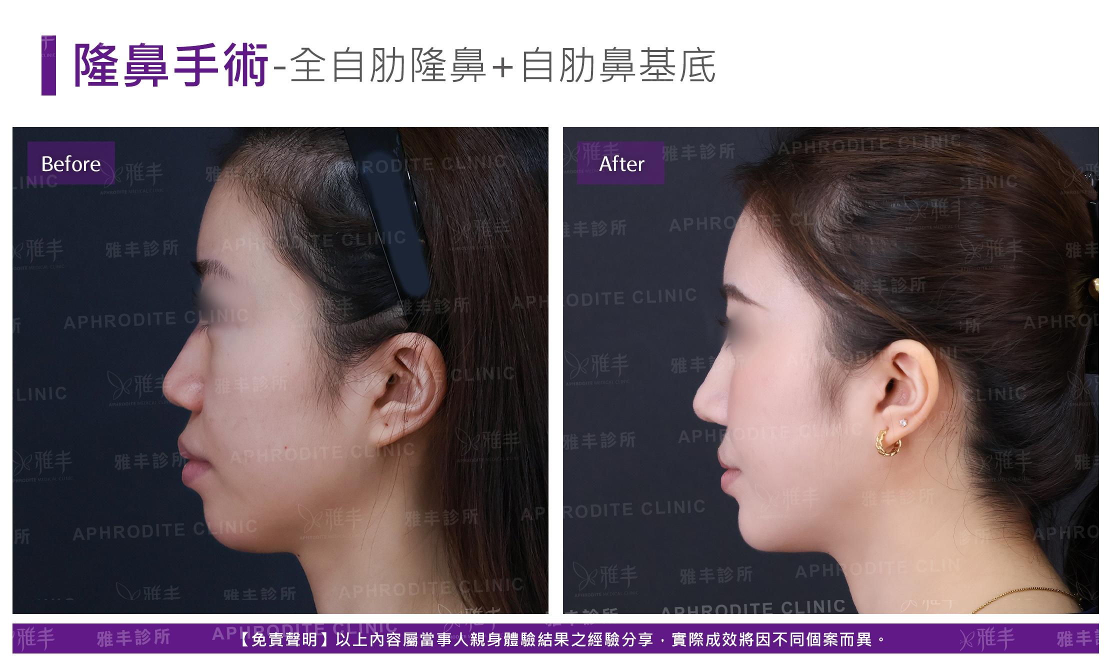 隆鼻手術-case26-L90.jpg