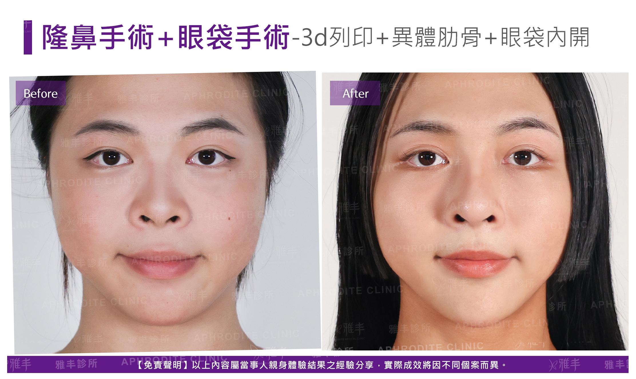 隆鼻手術-case27-F.jpg