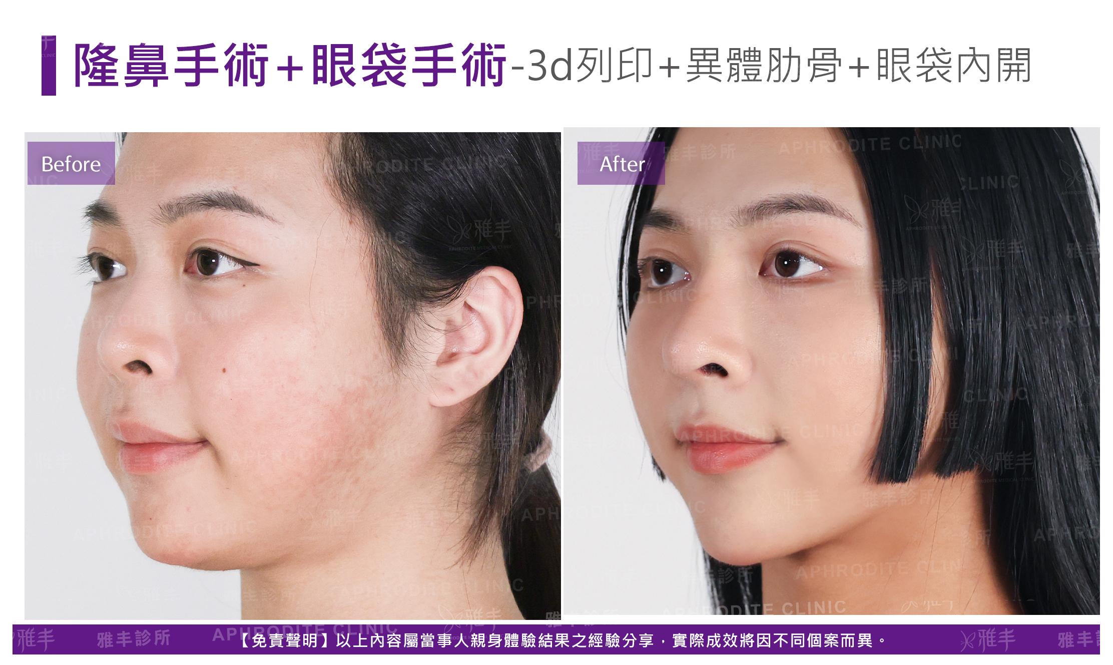 隆鼻手術-case27-L45.jpg