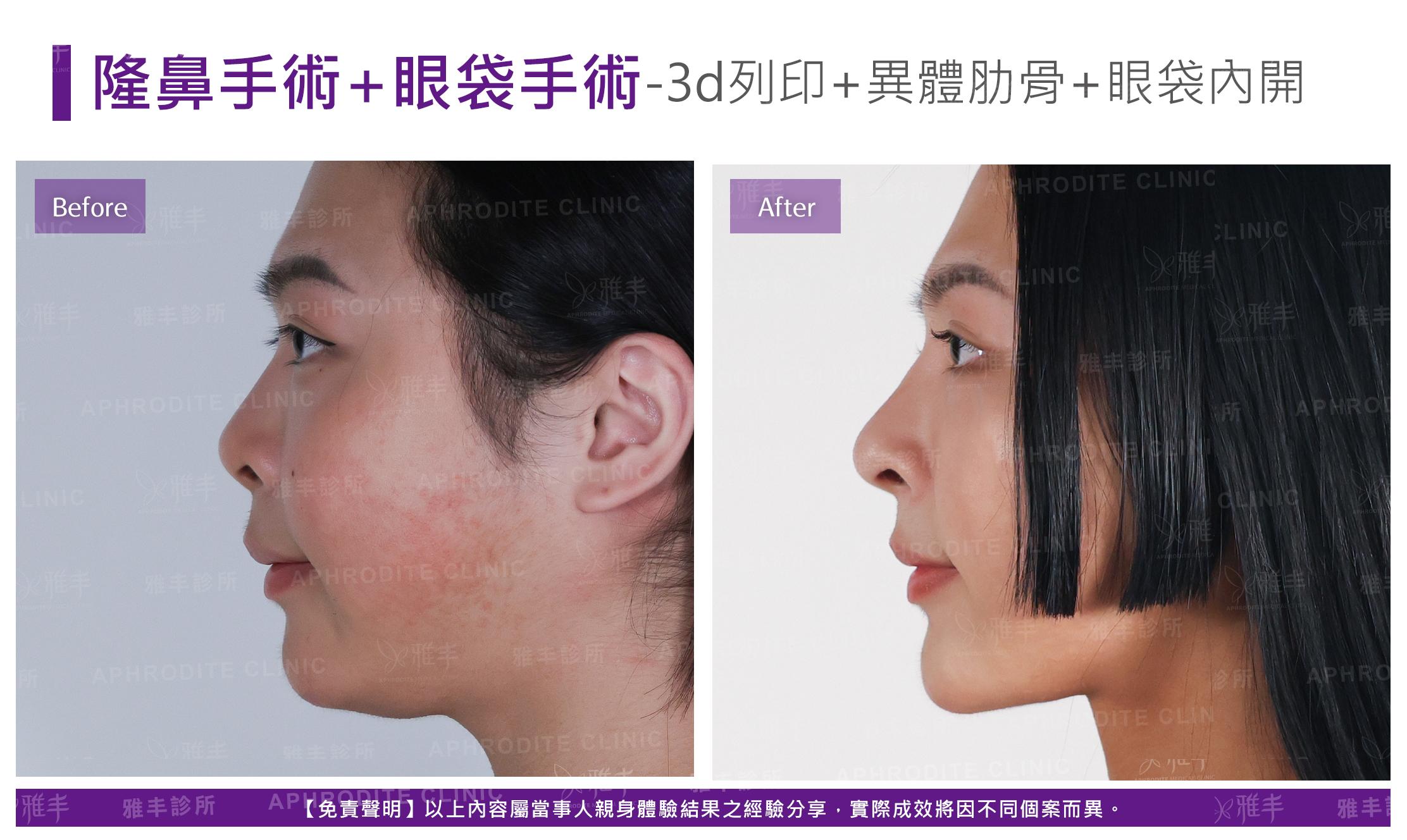 隆鼻手術-case27-L90.jpg