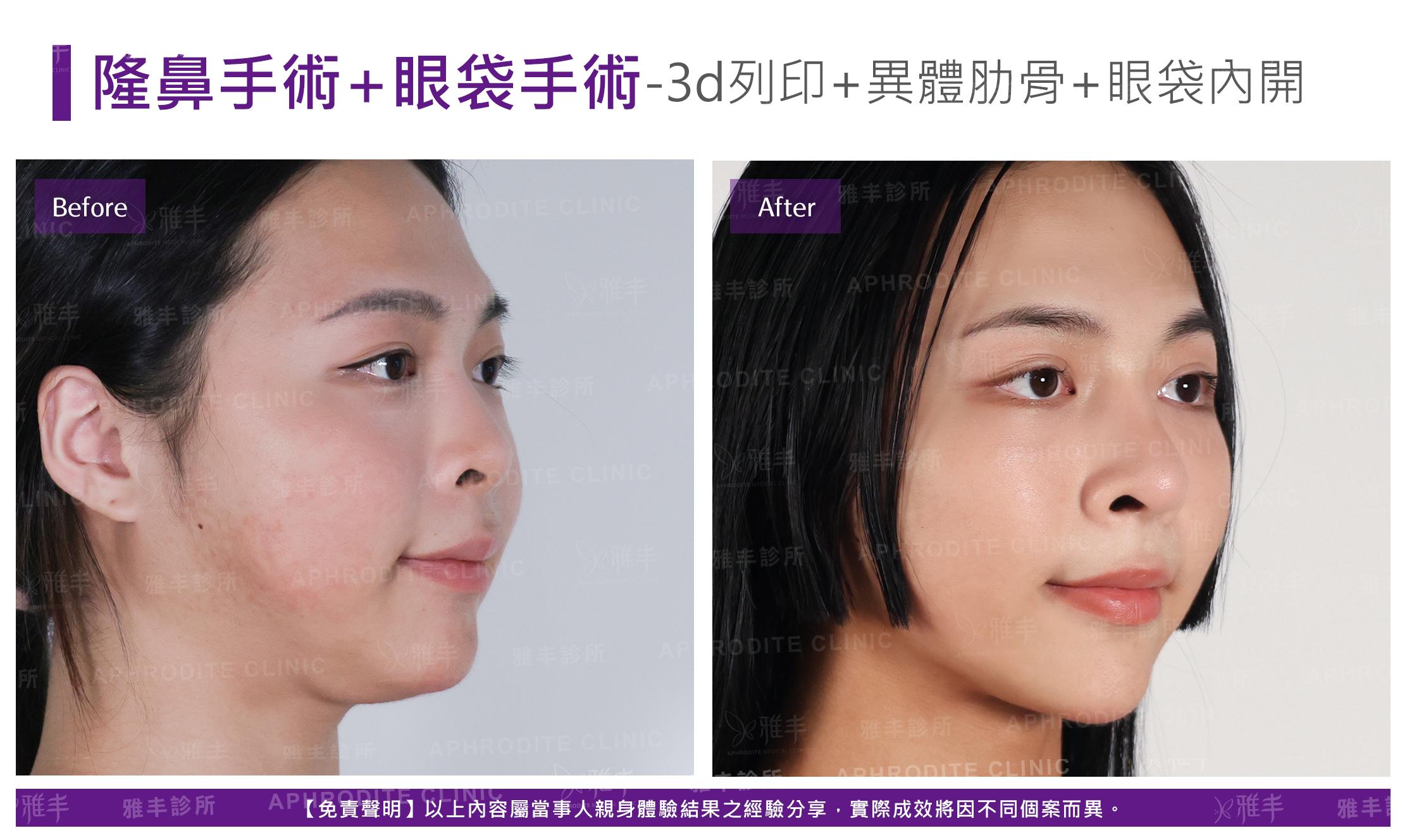 隆鼻手術-case27-R45.jpg