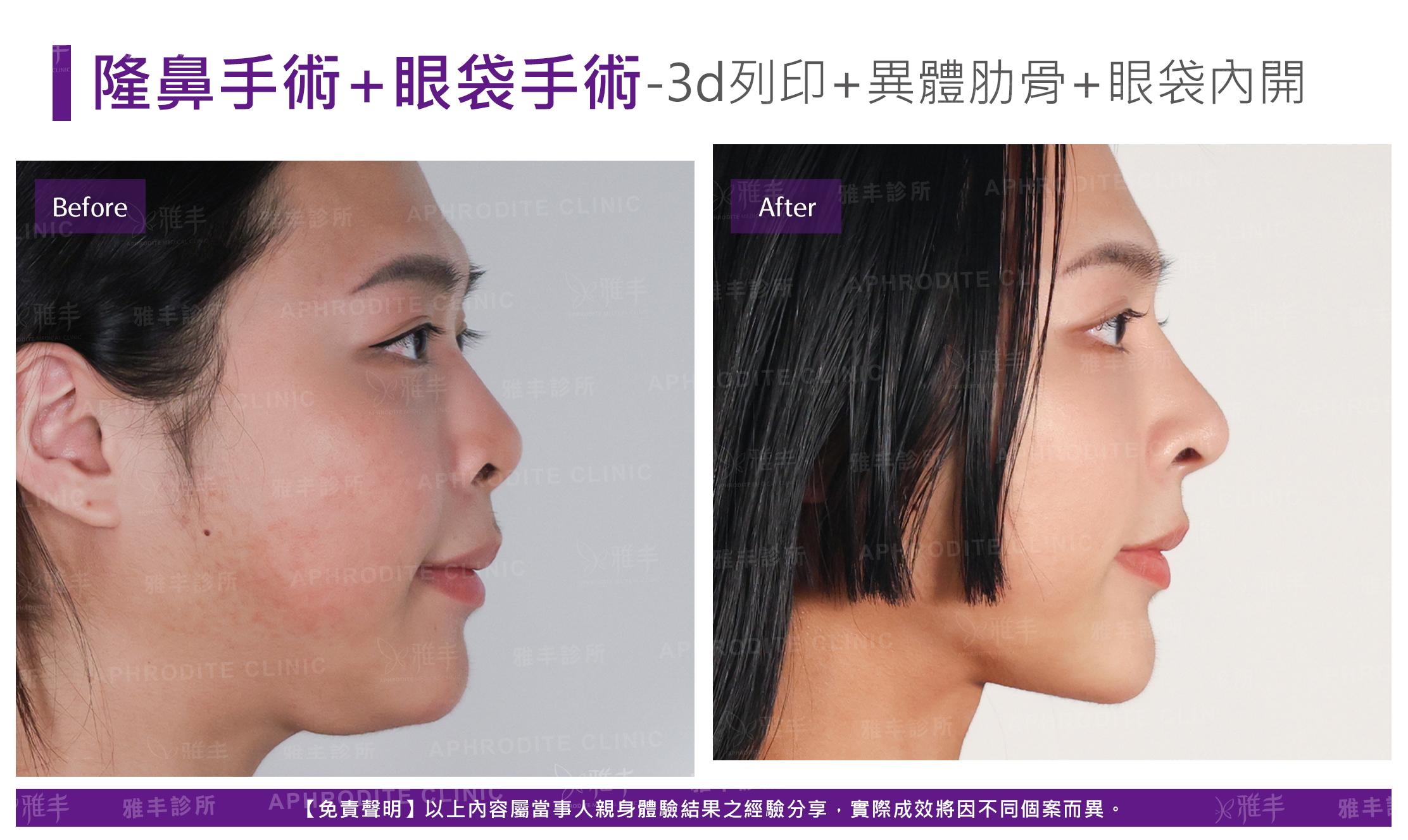 隆鼻手術-case27-R90.jpg