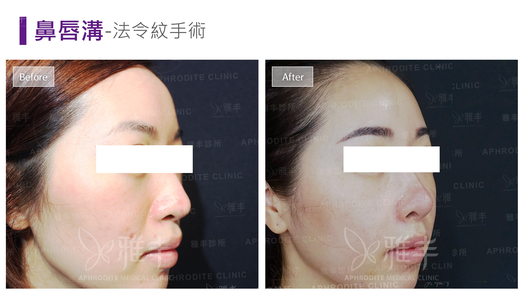 鼻唇溝-法令紋手術(Case1-R45)
