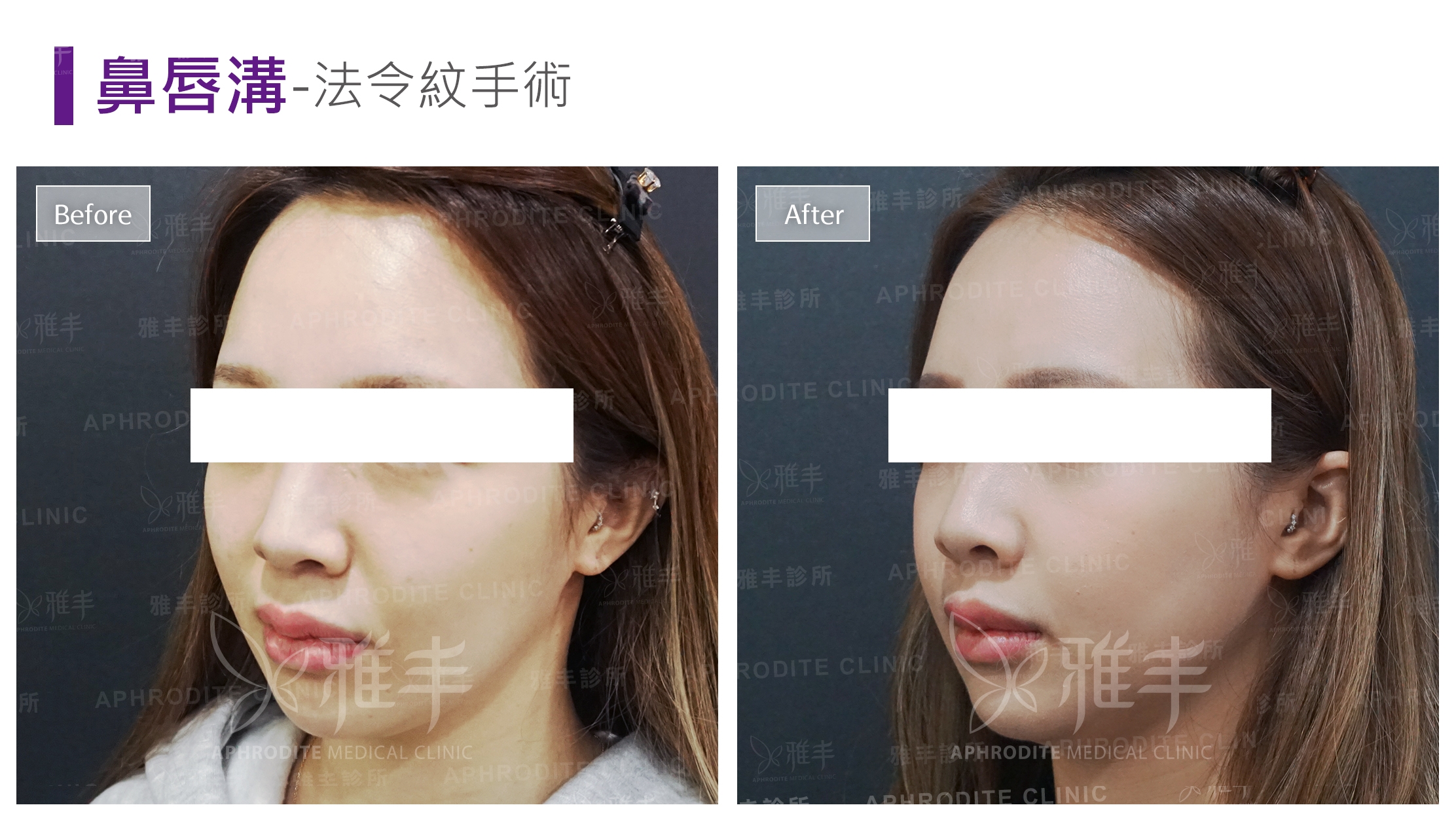 鼻唇溝-法令紋手術(Case2-L45)