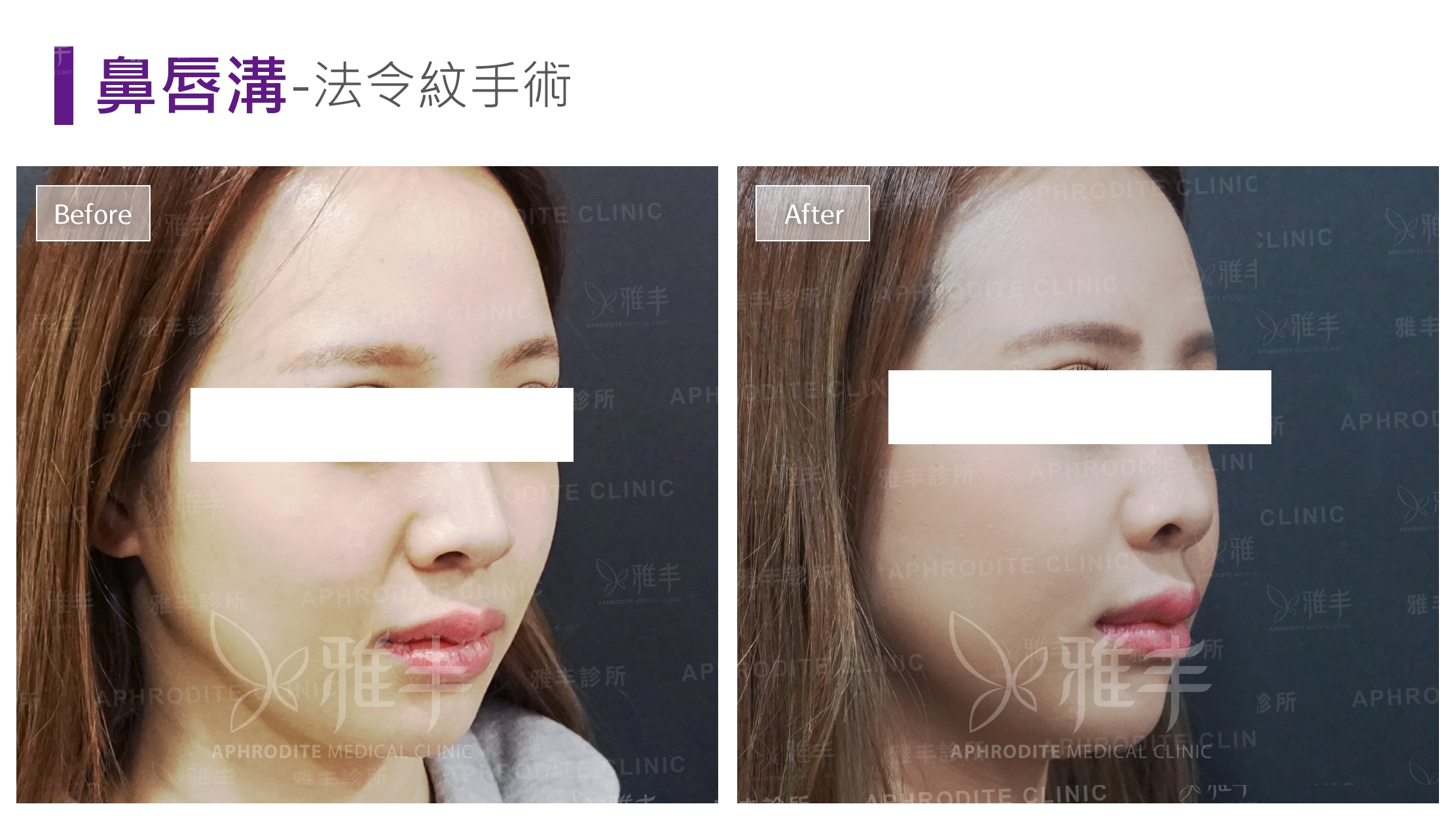 鼻唇溝-法令紋手術(Case2-R45)
