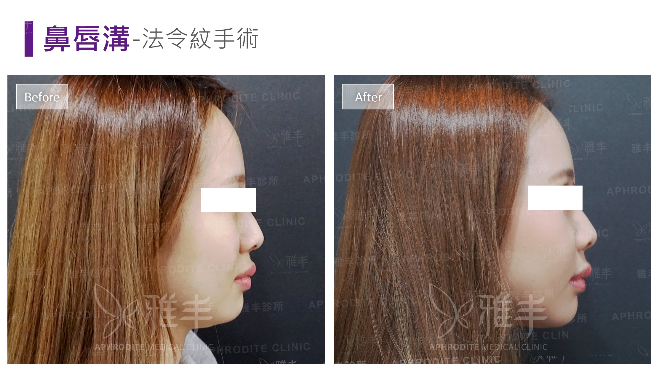 鼻唇溝-法令紋手術(Case2-R90)