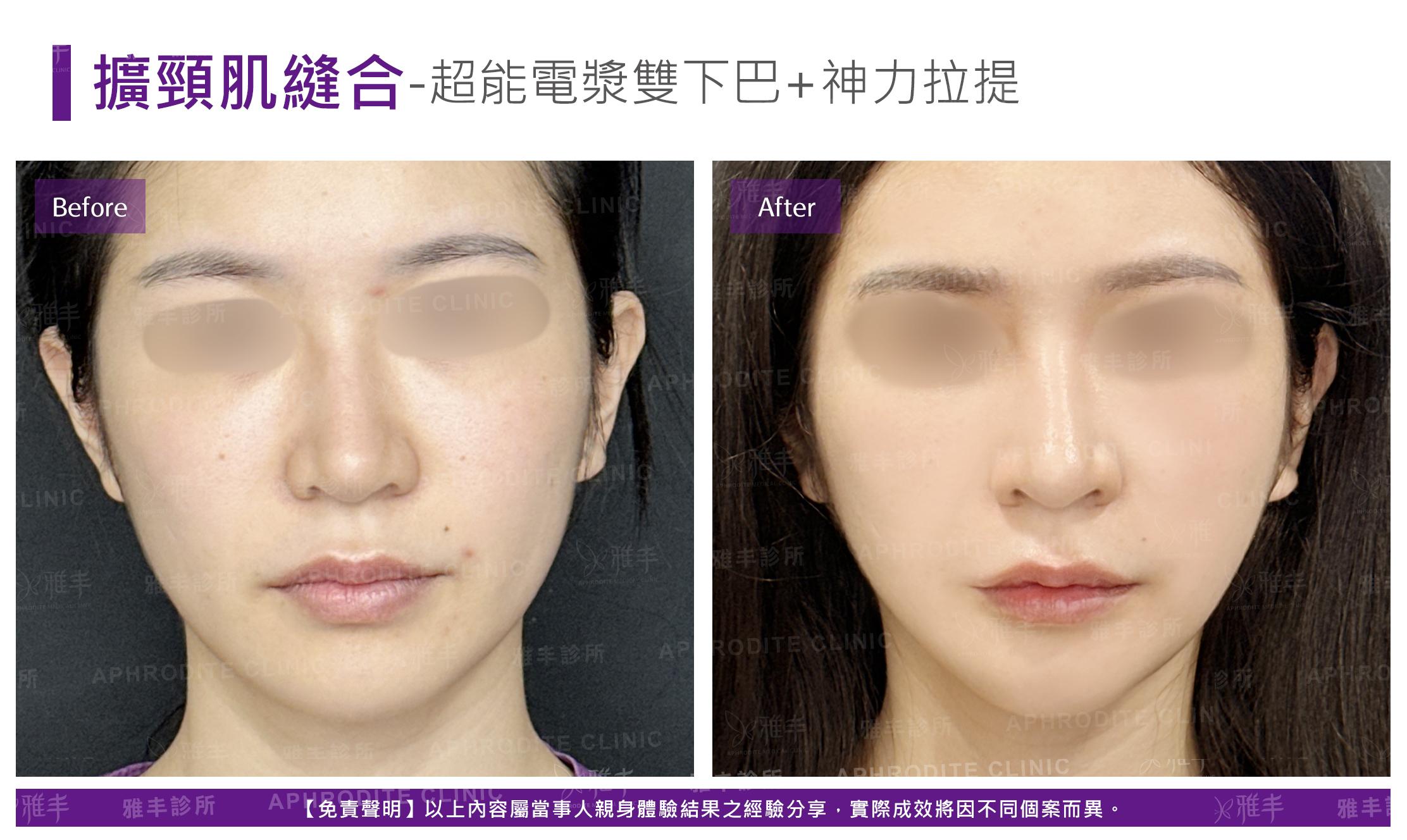 闊頸肌縫合-case3-F.jpg