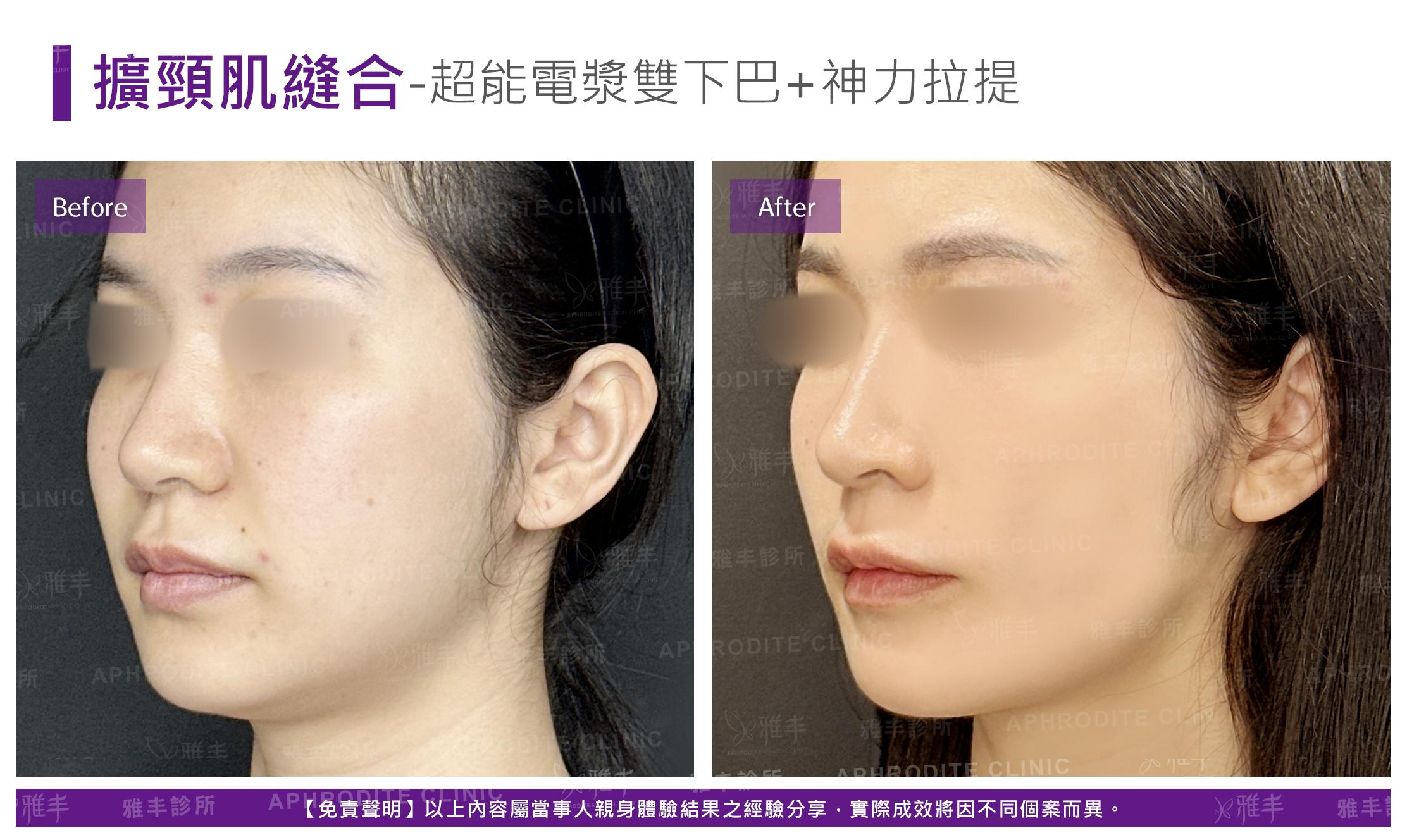 闊頸肌縫合-case3-L45.jpg