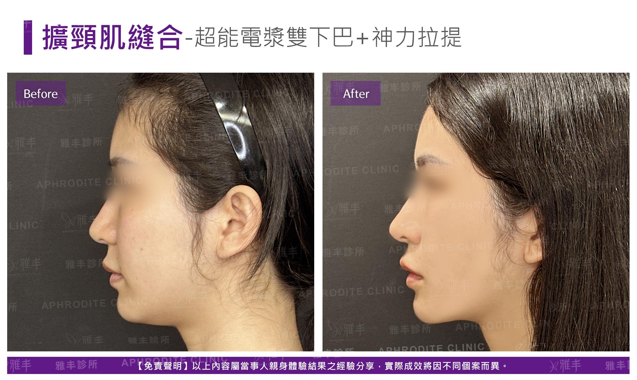 闊頸肌縫合-case3-L90.jpg
