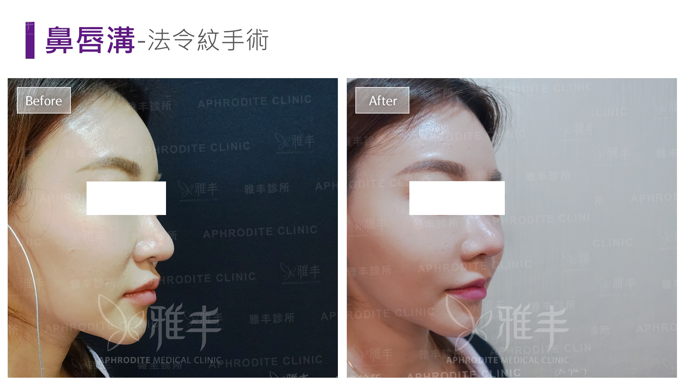 鼻唇溝-法令紋手術(Case3-R45)
