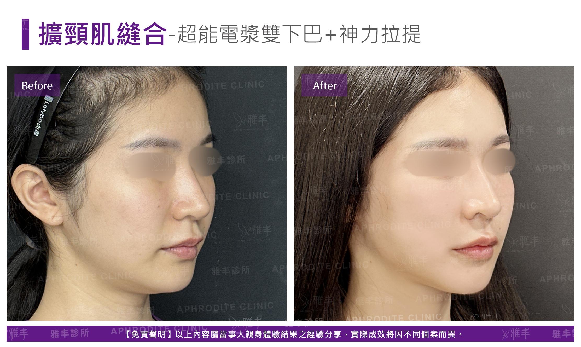 闊頸肌縫合-case3-R45.jpg