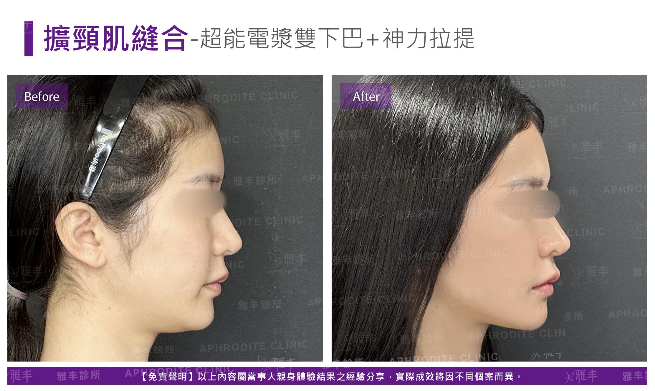 闊頸肌縫合-case3-R90.jpg