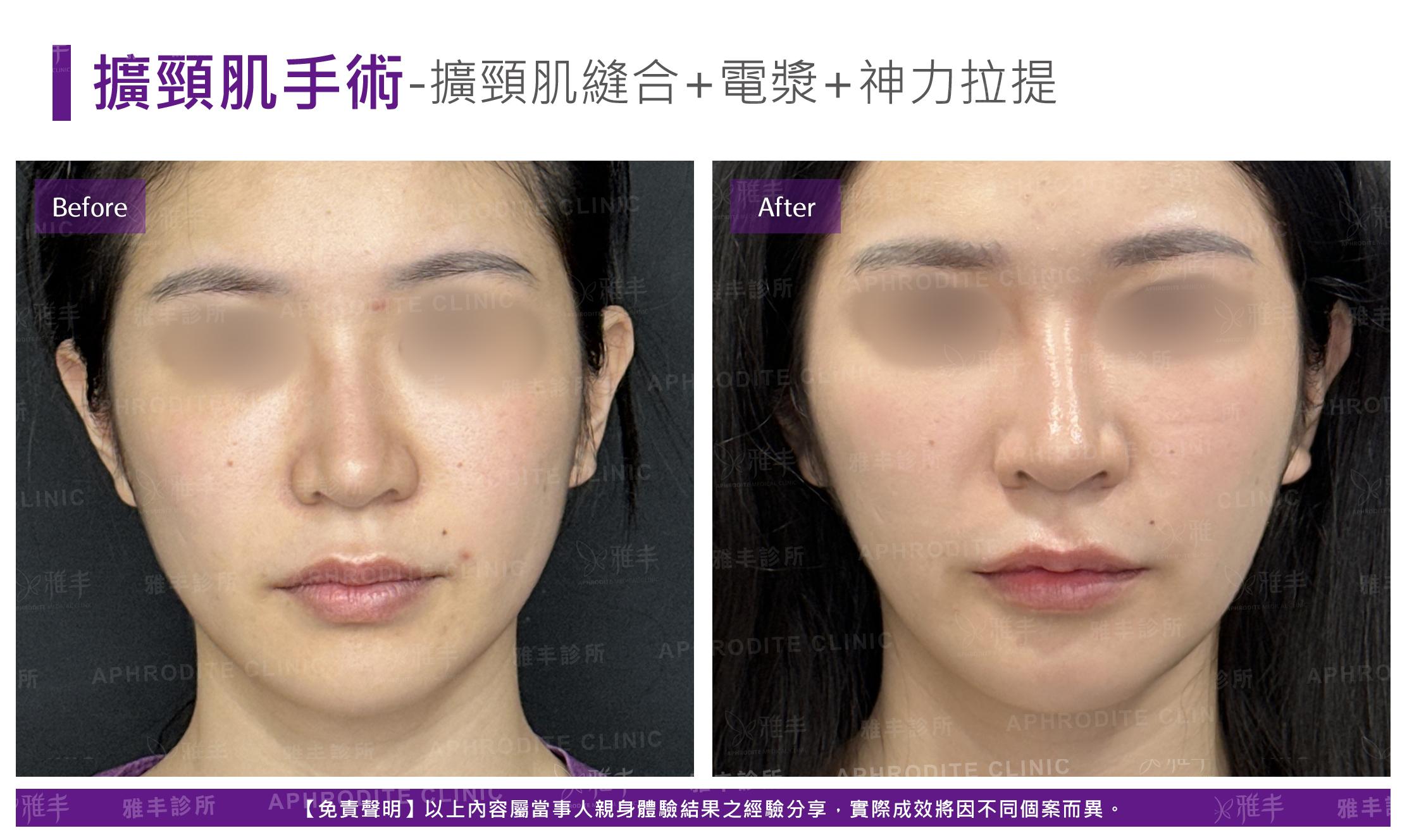 闊頸肌縫合-case4-F.jpg
