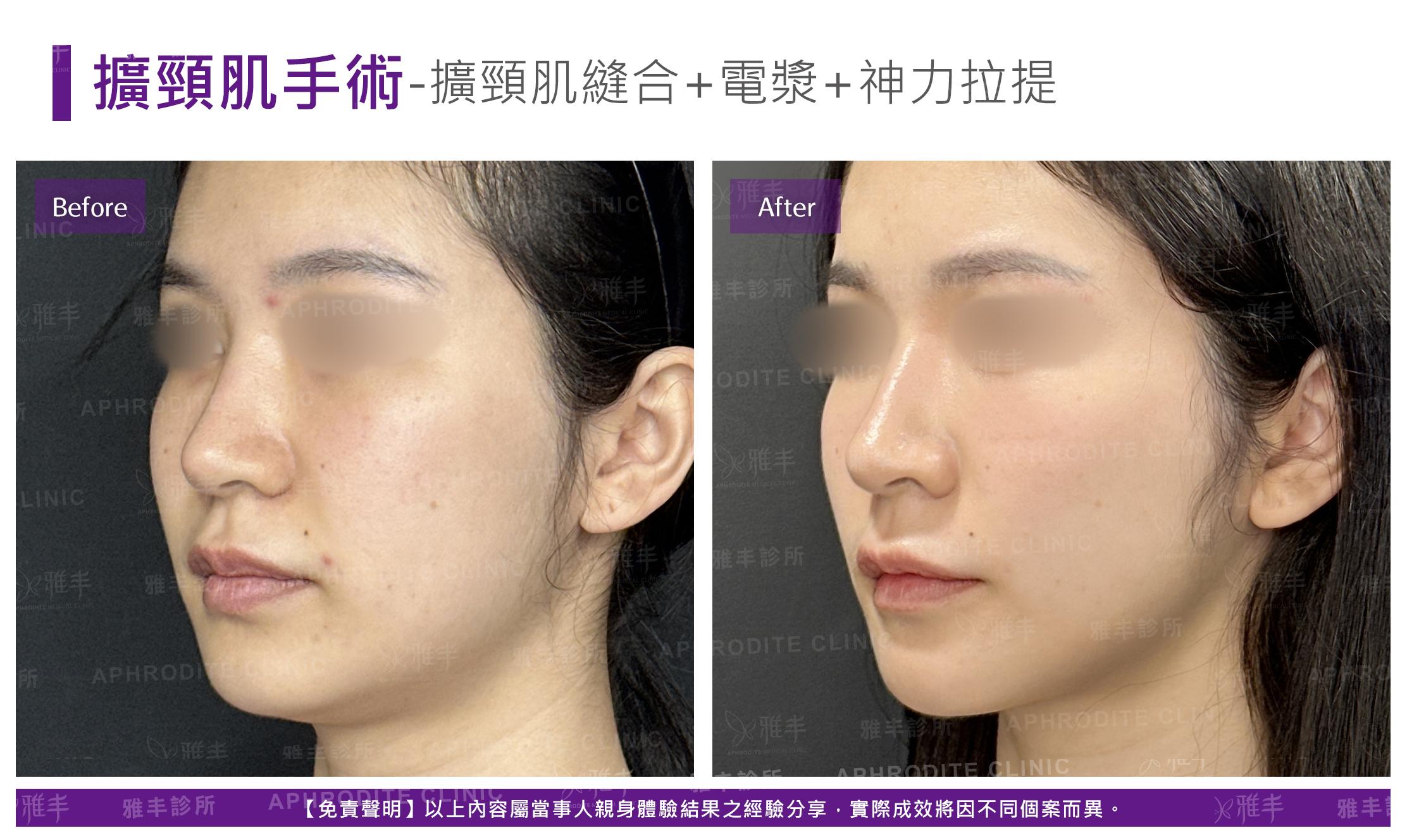 闊頸肌縫合-case4-L45.jpg