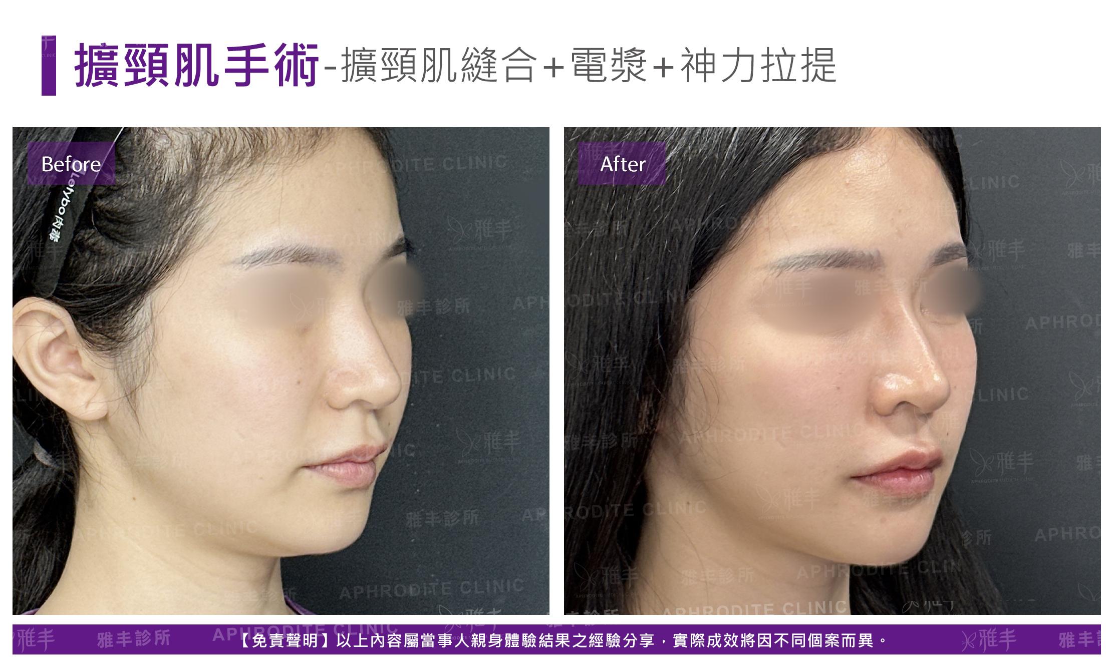 闊頸肌縫合-case4-R45.jpg